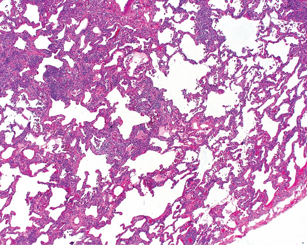 Figure 8.14, Nonspecific interstitial pneumonia. Variable widening of alveolar walls by chronic inflammation can be seen, with little if any spared alveolar parenchyma in the biopsy. Bronchovascular sheaths are also typically involved by the inflammatory process to a variable degree.