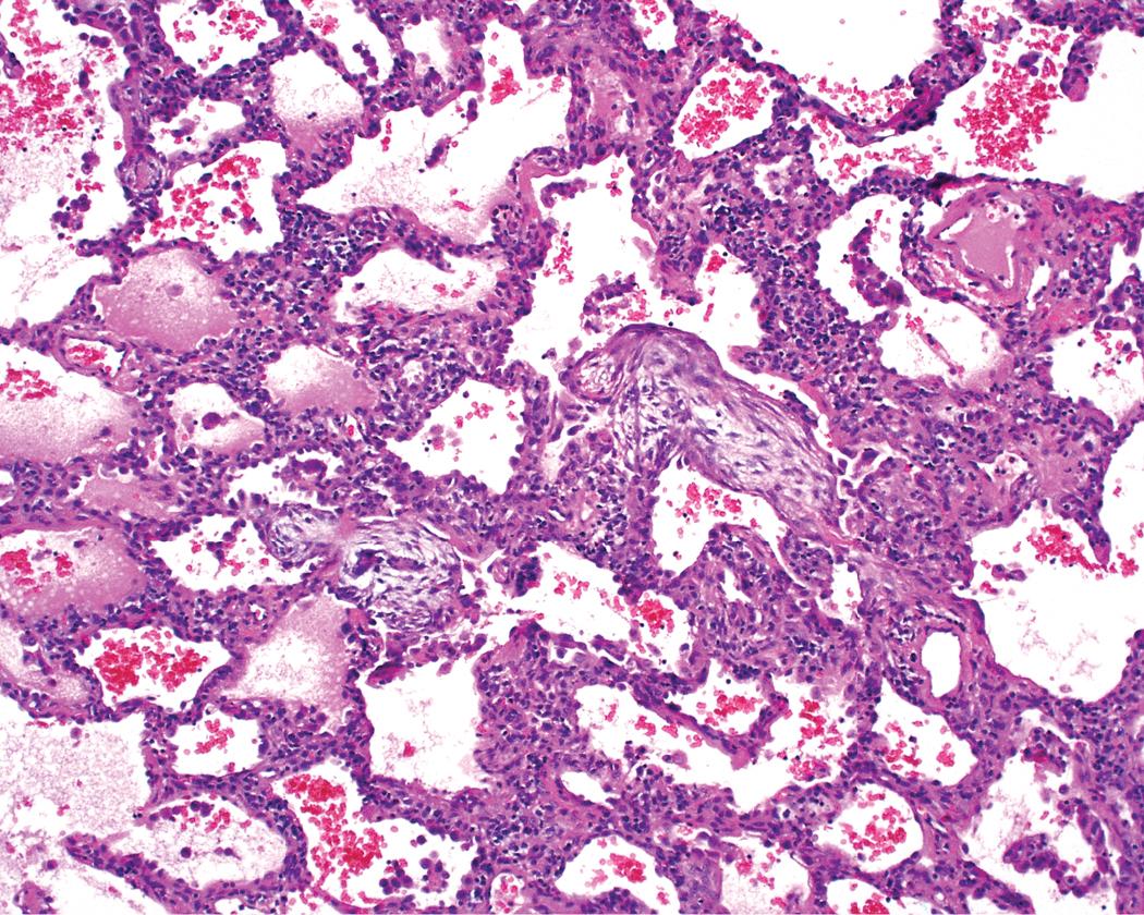 Figure 8.16, Nonspecific interstitial pneumonia. When airspace organization (organizing pneumonia pattern) is seen (center) , it is not diffusely or uniformly distributed, as might occur in organizing infectious pneumonia.