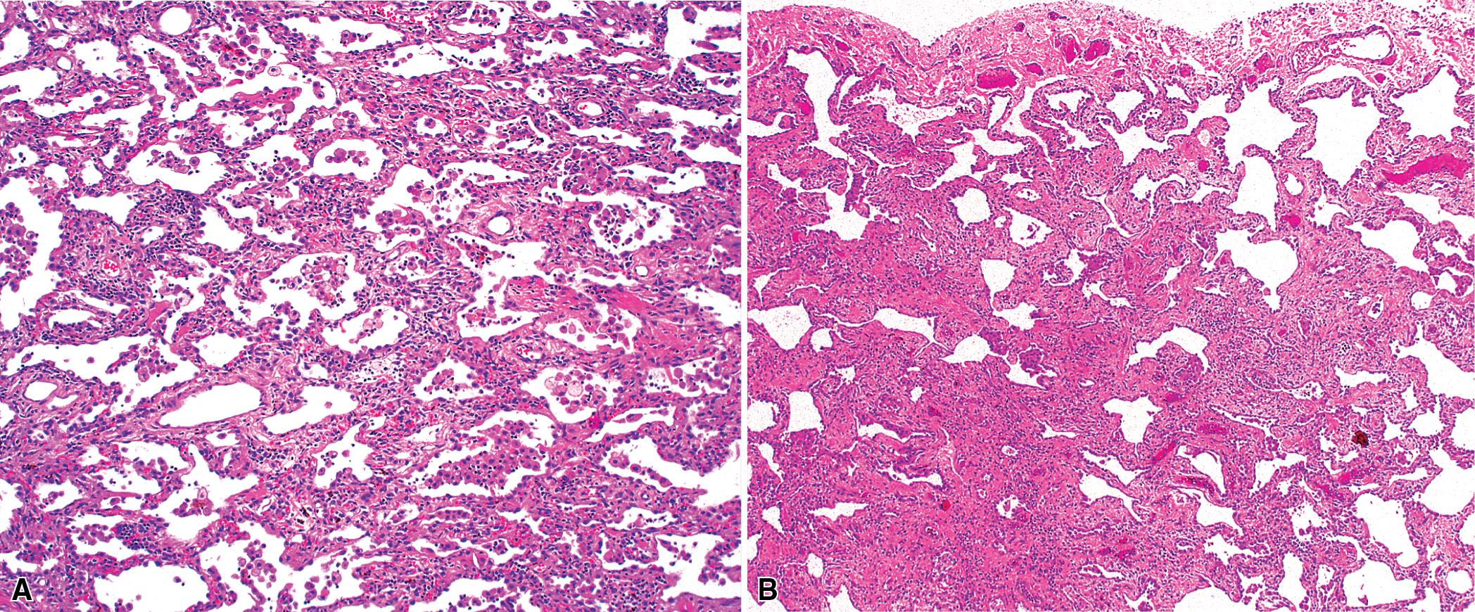 Figure 8.17, Nonspecific interstitial pneumonia (NSIP). When fibrosis occurs in NSIP (so-called fibrotic NSIP), it is usually mild to moderate in degree, with preservation of lung structure and generally without microscopic honeycombing or heterogeneity (i.e., normal lung adjacent to advanced fibrosis). (A) Changes of NSIP seen at low magnification. (B) Different specimen showing more prominent fibrosis.