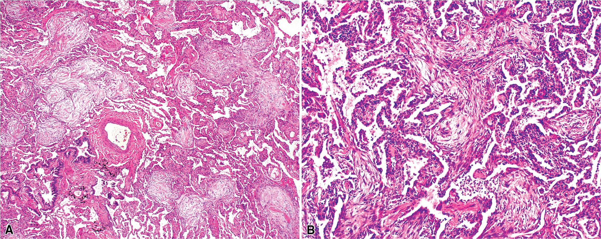 Figure 8.18, Organizing pneumonia pattern. This histopathologic pattern is characterized by variably dense airspace aggregates of loose fibroblasts within ground substance (immature collagen associated with an acellular pale or basophilic matrix). (A) At scanning magnification, slight nodularity of the process is evident. (B) At higher magnification, growth of loose granulation tissue can be seen within terminal airways and adjacent alveolar spaces.