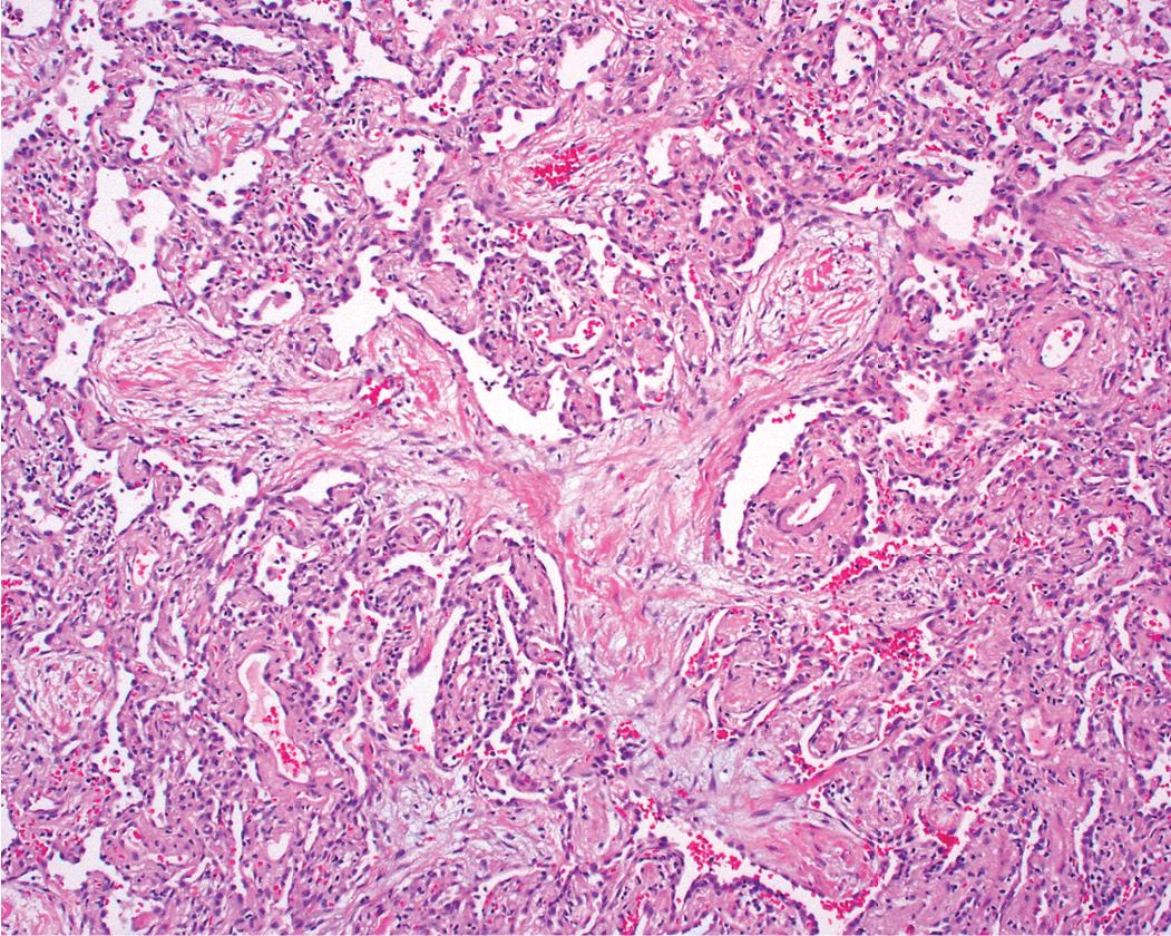 Figure 8.19, Organizing pneumonia pattern. A branching tongue of fibroblastic proliferation can be seen to extend into or from an alveolar duct. Note the mild inflammatory interstitial infiltrate in surrounding alveolar walls.