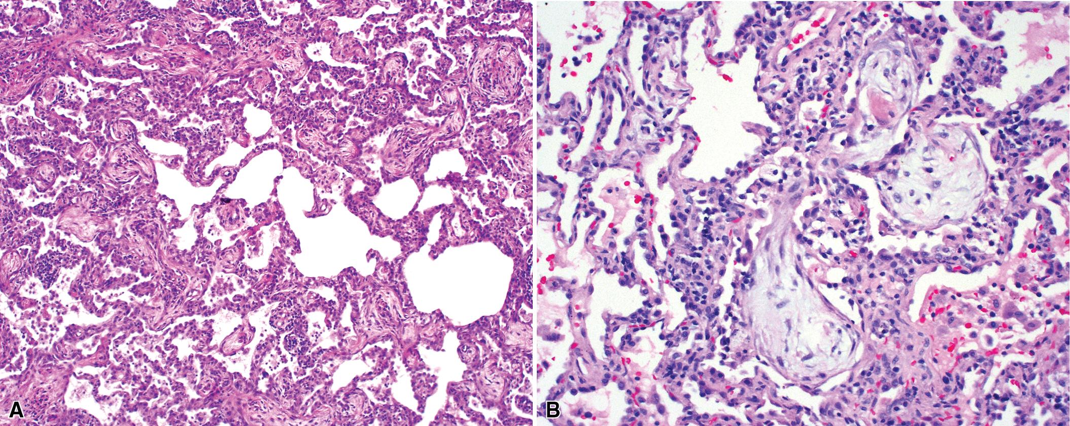 Figure 8.20, Organizing pneumonia pattern. In cryptogenic organizing pneumonia (COP), the lung architecture is typically preserved. Lymphocytes, plasma cells, and histiocytes are present to variable degree within the interstitium. (A) Note the very patchy organization. (B) The prototypical appearance of COP, with patchy organization and mild interstitial pneumonia.