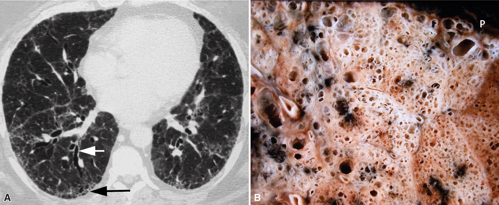 Figure 8.2, Usual interstitial pneumonia (UIP). (A) Computed tomography scan showing characteristic changes of UIP, with subpleural cysts (black arrow) and traction bronchiectasis (white arrow) . (B) Gross lung specimen shows subpleural (P) cysts, ranging from a few millimeters to a centimeter or more in diameter (i.e., radiologic honeycombing), which increase in prominence as the disease advances.