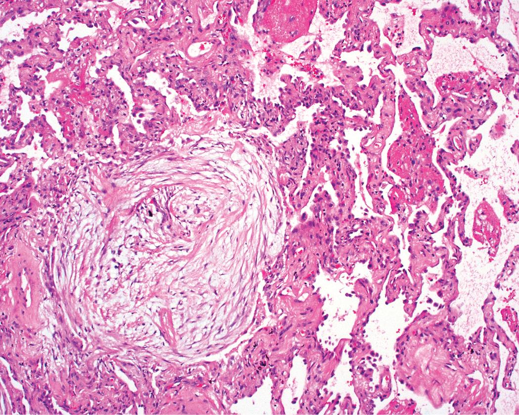 Figure 8.21, Organizing pneumonia pattern. Fibrin (center right) may be seen focally in association with airspace organization (center left) in cryptogenic organizing pneumonia.