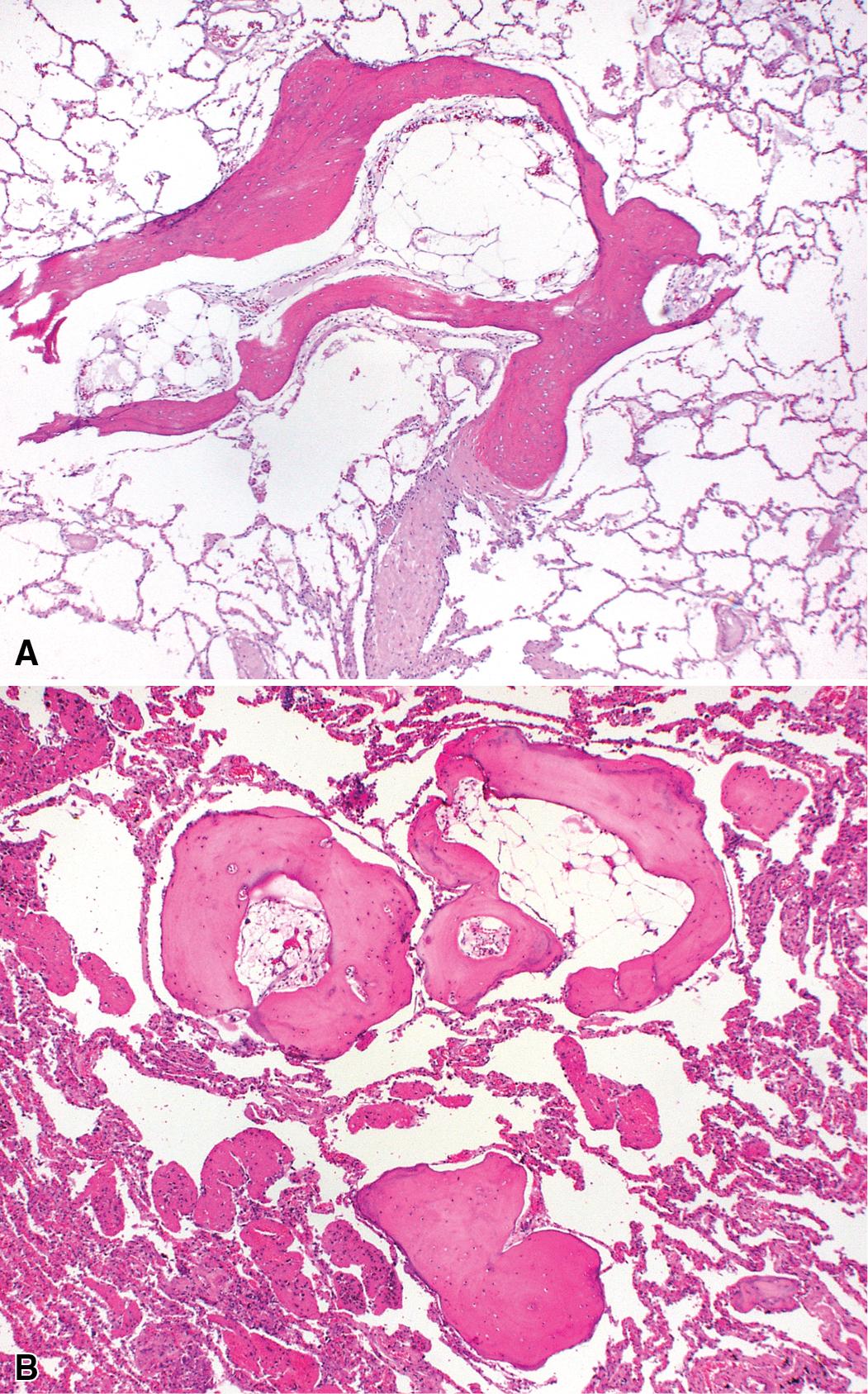 Figure 8.22, Racemose (dendriform) alveolar calcification. (A and B) Rarely, airspace organization may ossify, producing “racemose” or “dendriform” ossification.