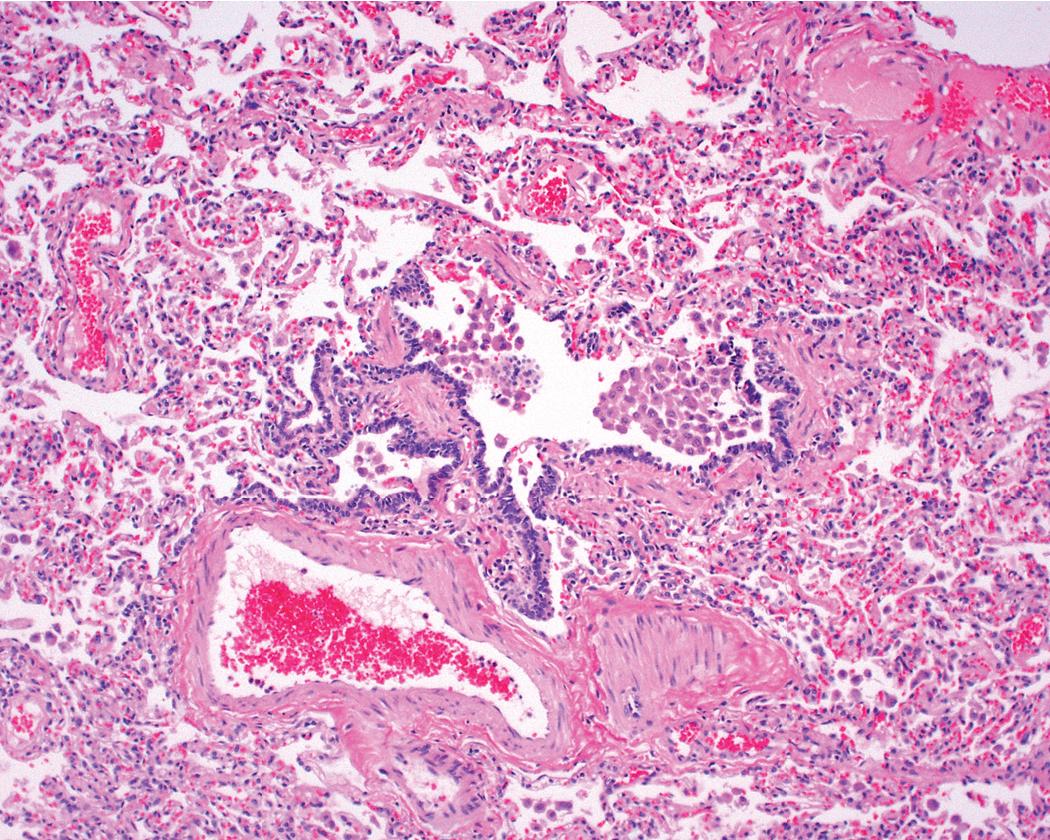 Figure 8.24, Respiratory bronchiolitis. This pathologic process is characterized by the presence of scant inflammation around the terminal airways.