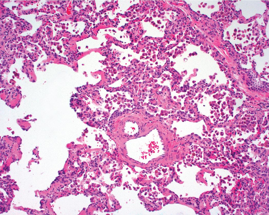 Figure 8.26, Respiratory bronchiolitis. Variable numbers of lightly pigmented (dusty brown) airspace macrophages are seen within bronchiolar lumens and in immediately surrounding alveoli.