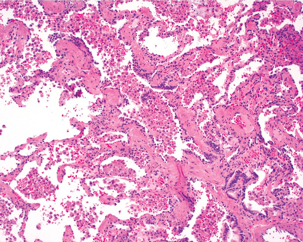 Figure 8.27, Respiratory bronchiolitis. Scant peribronchiolar fibrosis may be present; this may extend to involve contiguous alveolar walls, with or without prominent smooth muscle bundles.