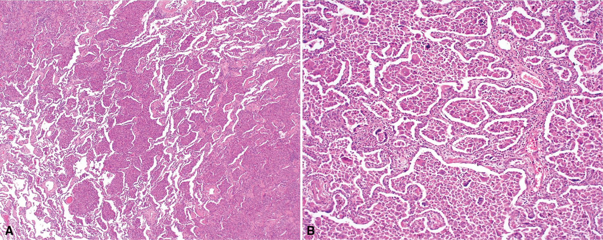 Figure 8.28, Desquamative interstitial pneumonia (DIP). (A) DIP is often a scanning magnification diagnosis. (B) The surgical lung biopsy has an eosinophilic appearance owing to the presence of eosinophilic macrophages uniformly filling airspaces.