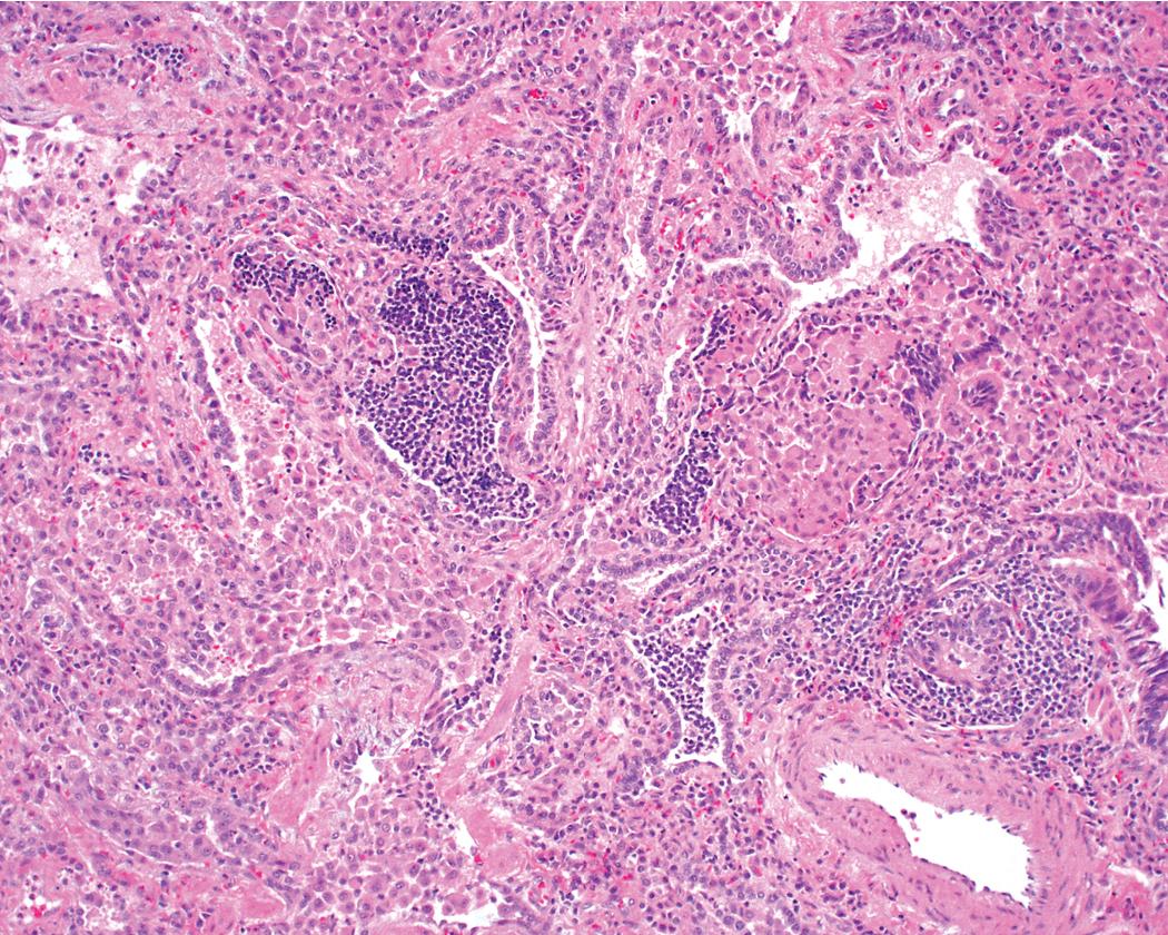 Figure 8.30, Desquamative interstitial pneumonia (DIP). When chronic inflammation is evident in DIP at scanning magnification, it is centrilobular and associated with respiratory bronchioles.