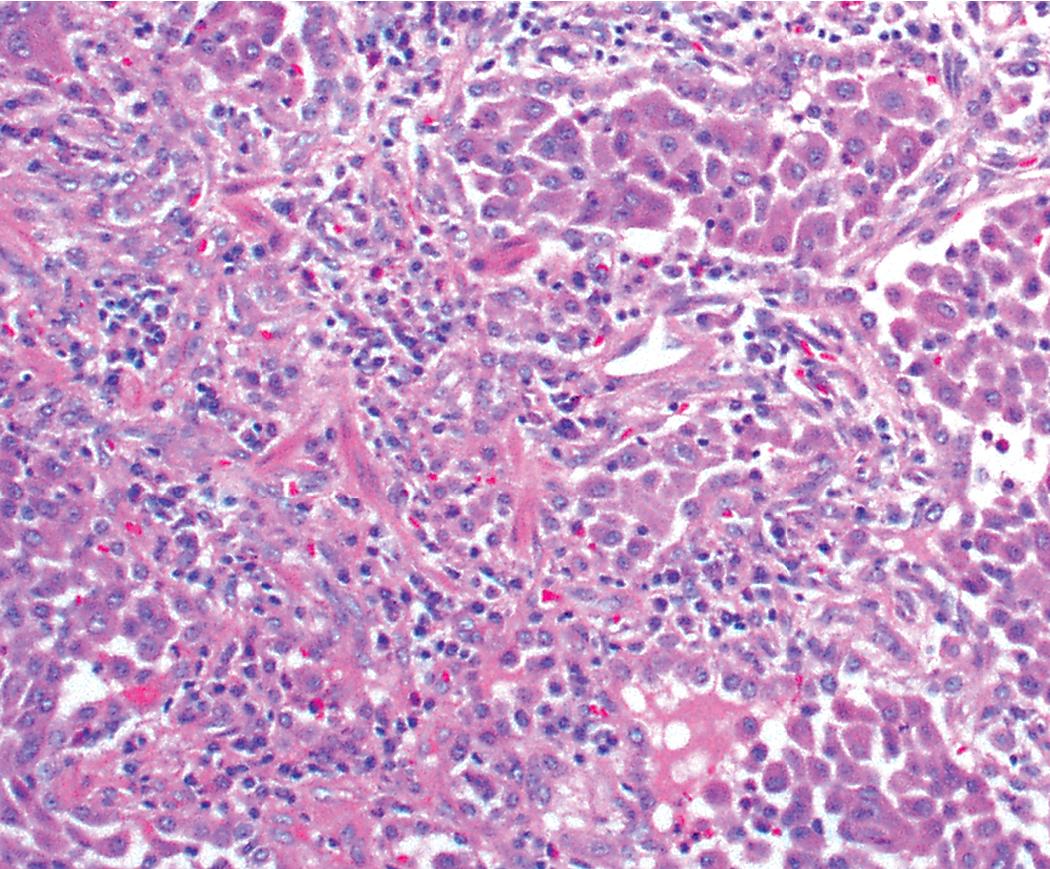 Figure 8.31, Desquamative interstitial pneumonia. Scant numbers of plasma cells and rare eosinophils may be seen within slightly thickened alveolar walls at high magnification.