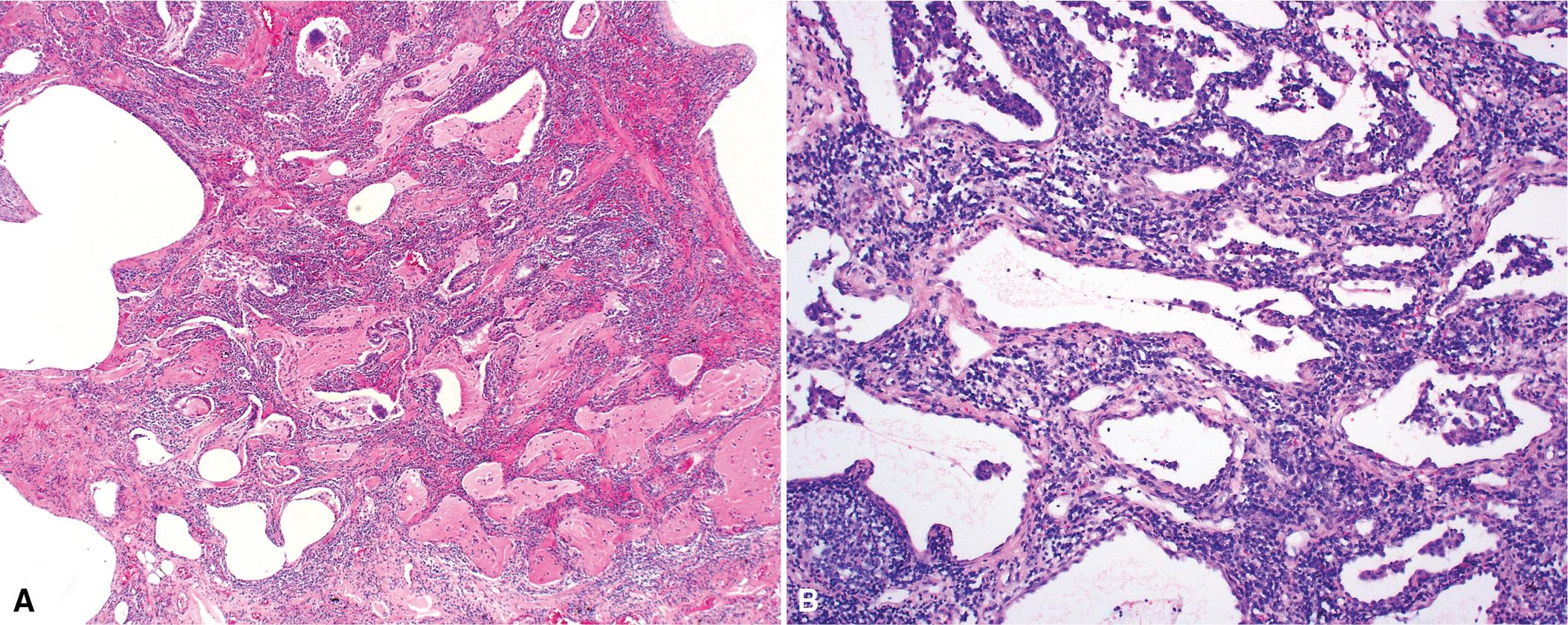 Figure 8.33, Lymphoid interstitial pneumonia (LIP). Microscopic honeycomb cystic remodeling (A) with some interstitial fibrosis (B); these can also be components of idiopathic LIP.