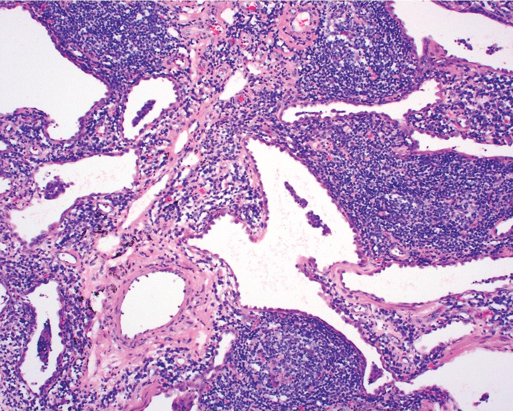 Figure 8.34, Lymphoid interstitial pneumonia. Germinal centers may be present to a variable extent along airways and lymphatic routes. When these are prominent, diffuse lymphoid hyperplasia has been used as a preferable alternative term for this clinical entity.
