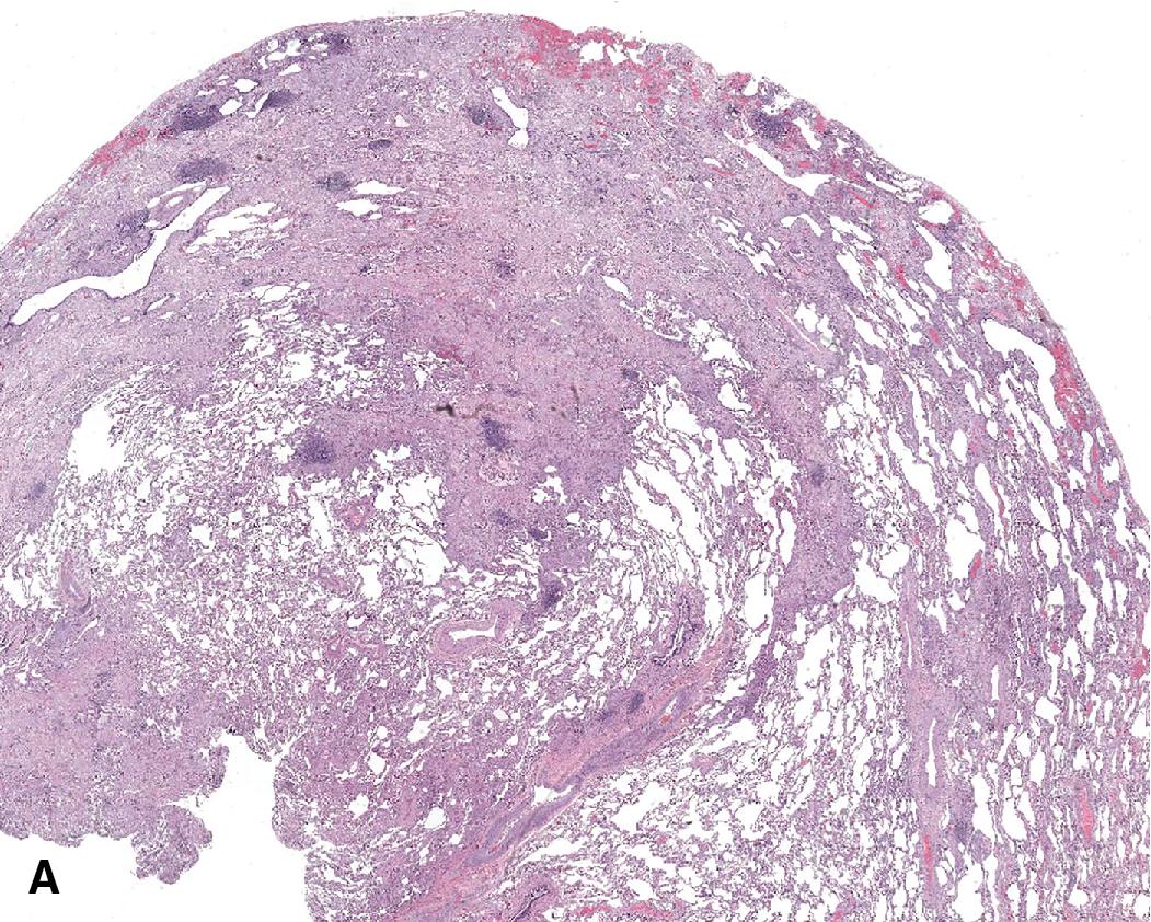 Figure 8.35, Idiopathic pleuroparenchymal fibroelastosis (IPPFE). (A) An upper lobe biopsy seen at scanning magnification from a patient with IPPFE. Note the elastotic fibrosis in a subpleural location, extending deep into the lung parenchyma. (B) At higher power, the elastic rich nature of the fibrotic process is appreciated. Elastic tissue stains are rarely required.