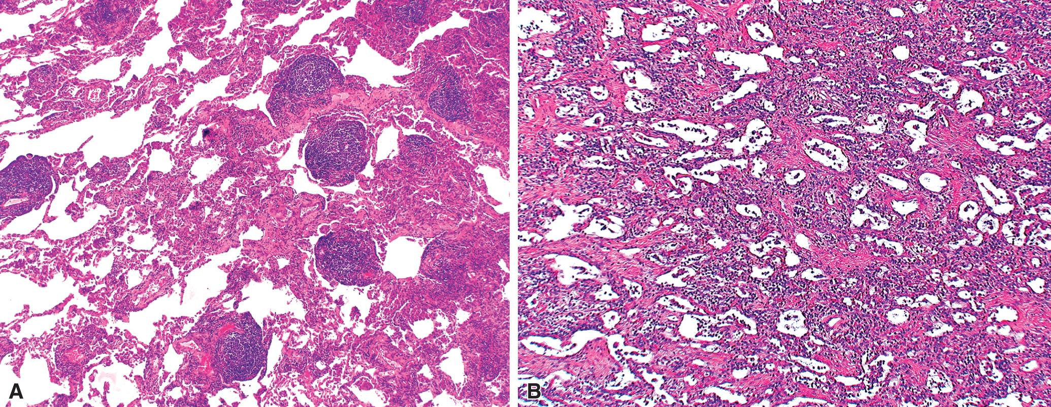 Figure 8.36, Rheumatoid arthritis (RA) lung disease. (A) Chronic inflammation typically manifests in RA lung as lymphoid aggregates and follicular lymphoid germinal centers. (B) A variably cellular chronic interstitial infiltrate rich in plasma cells and lymphocytes is typical.