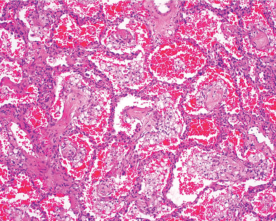 Figure 8.38, Rheumatoid arthritis lung disease. Areas of subacute lung injury, attended by reactive-type II cells and airspace organization, can be seen. Fresh hemorrhage, probably related to the biopsy procedure, is also evident.