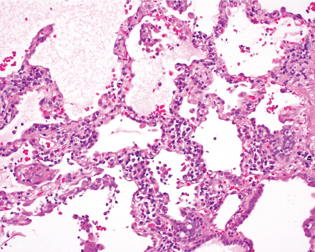 Figure 8.39, Rheumatoid arthritis (RA) lung disease. The cellular interstitial pneumonia of RA may be attended by diffuse reactive type II cell hyperplasia, but this finding is not particularly diagnostic absent other features more characteristic of RA (lymphoid germinal centers, follicular bronchiolitis, pleuritis, rheumatoid nodules).