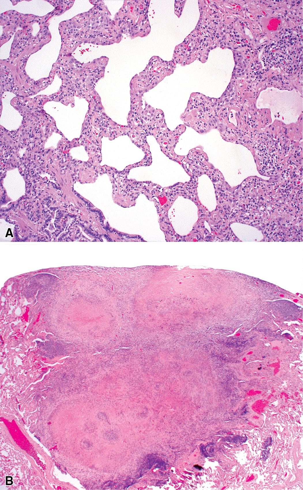 Figure 8.40, Rheumatoid arthritis (RA) lung disease. (A) Variable interstitial fibrosis is typical and often resembles the fibrotic form of nonspecific interstitial pneumonia. (B) Typical rheumatoid nodules may occur in RA lung and must be distinguished from lesions seen with infection and in granulomatosis with polyangiitis.
