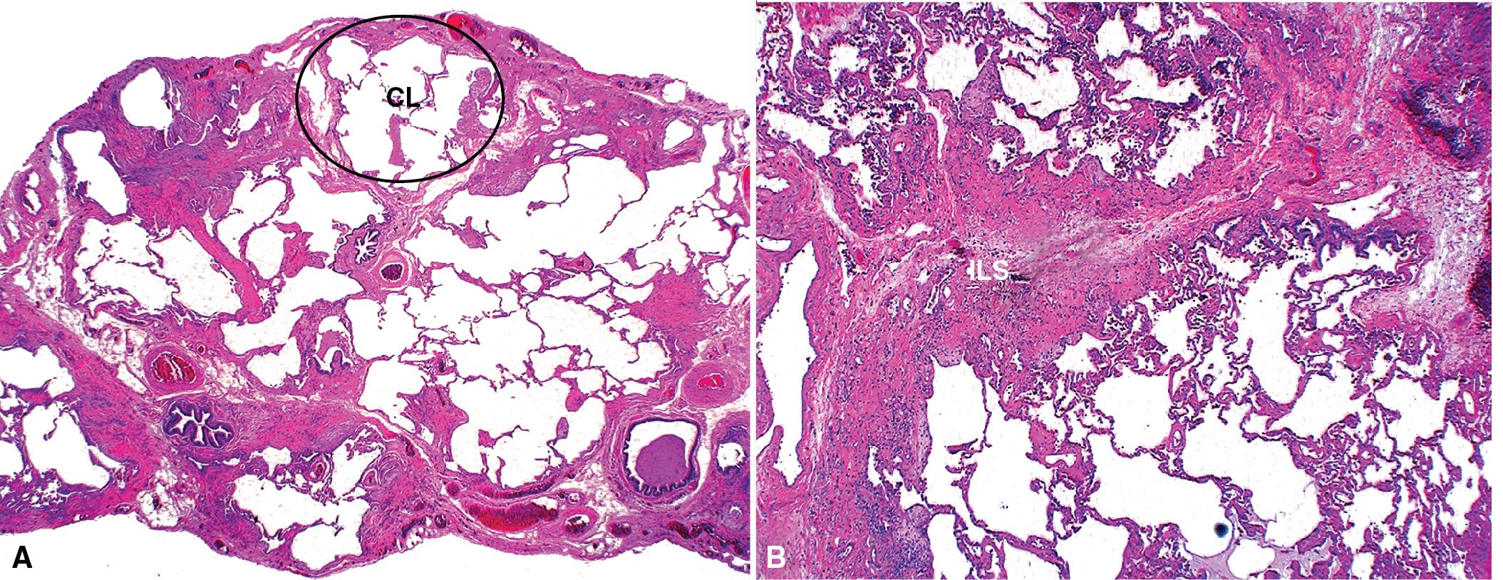 Figure 8.4, Usual interstitial pneumonia (UIP). (A) The remodeled lung is present mainly beneath the pleura and at the periphery of the secondary lobule, adjacent to interlobular septa. A slightly shrunken lobule is circled at upper center. (B) An interlobular septum (ILS) widened by fibrosis is seen at center, with less involved lung lobules above and below. CL , Center of lobule.