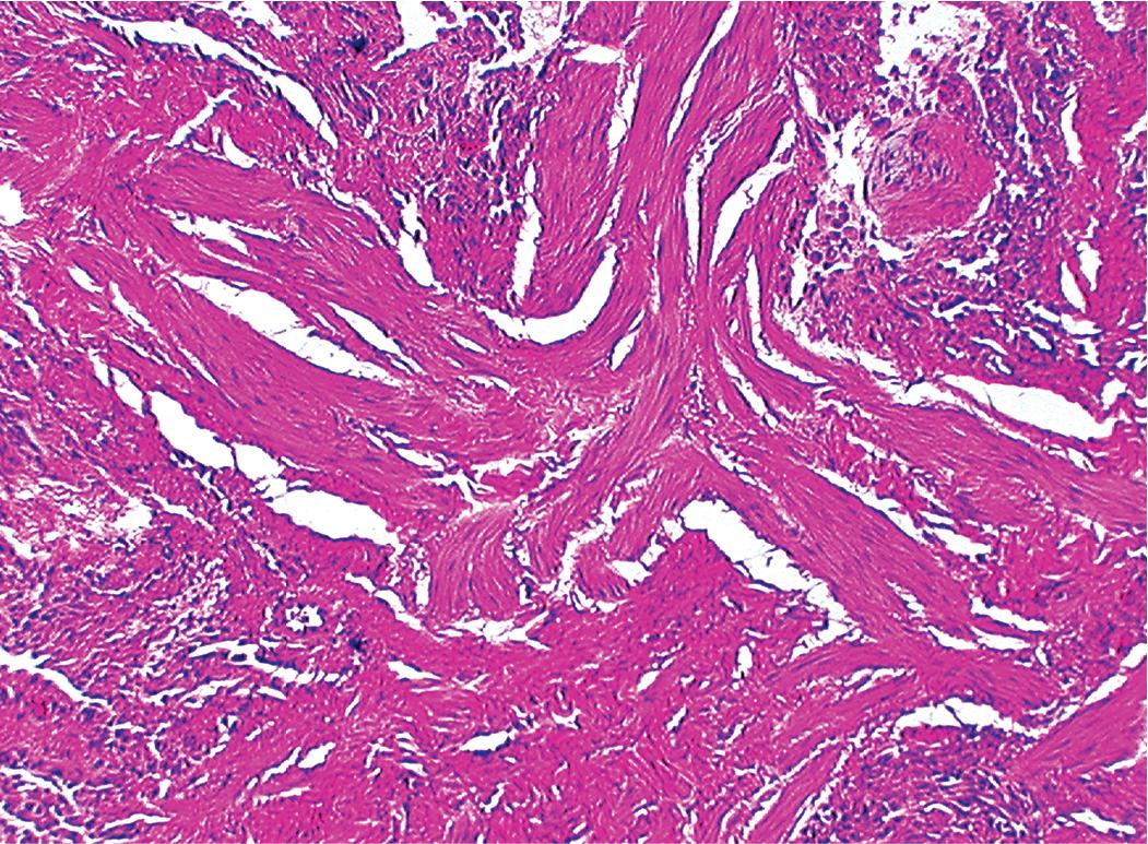 Figure 8.5, Usual interstitial pneumonia (UIP). When UIP is recognizable as a distinct pathologic entity, the subpleural fibrous tissue contains areas of smooth muscle proliferation, seen here as large, disorganized fascicles.