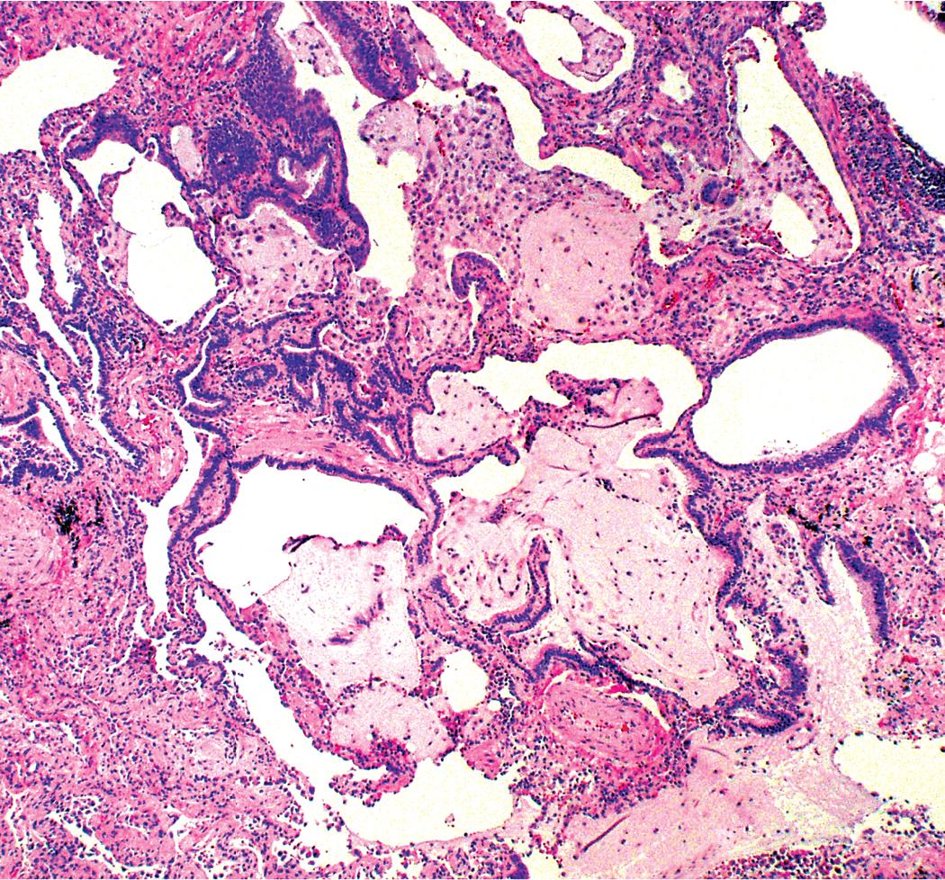 Figure 8.6, Usual interstitial pneumonia. Even in patients with early disease as determined radiologically, foci of microscopic honeycombing typically are present. To distinguish bronchiolar metaplasia from microscopic honeycombing, noting the location of the lesion is often helpful because microscopic honeycombing is present more peripherally in lobules and associated with dense scar, whereas bronchiolar metaplasia develops at the center of lobules, in association with respiratory bronchioles.