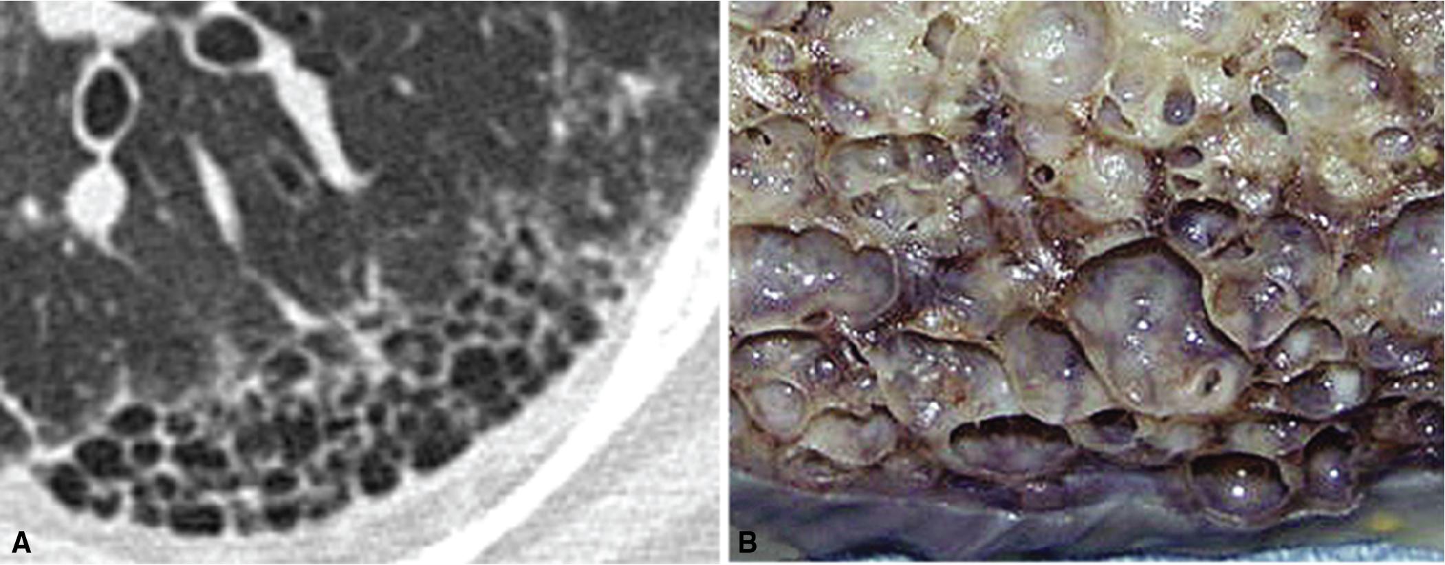 Figure 8.7, Usual interstitial pneumonia (UIP). As used by radiologists, the term honeycombing refers to an array of much larger cysts (in the range of 0.5 to 3 cm or more in diameter) as a localized manifestation of advanced lung remodeling. (A) A patient with advanced UIP has many peripheral honeycomb cysts and traction bronchiectasis. (B) The gross lung shows dramatic confluent cyst formation.