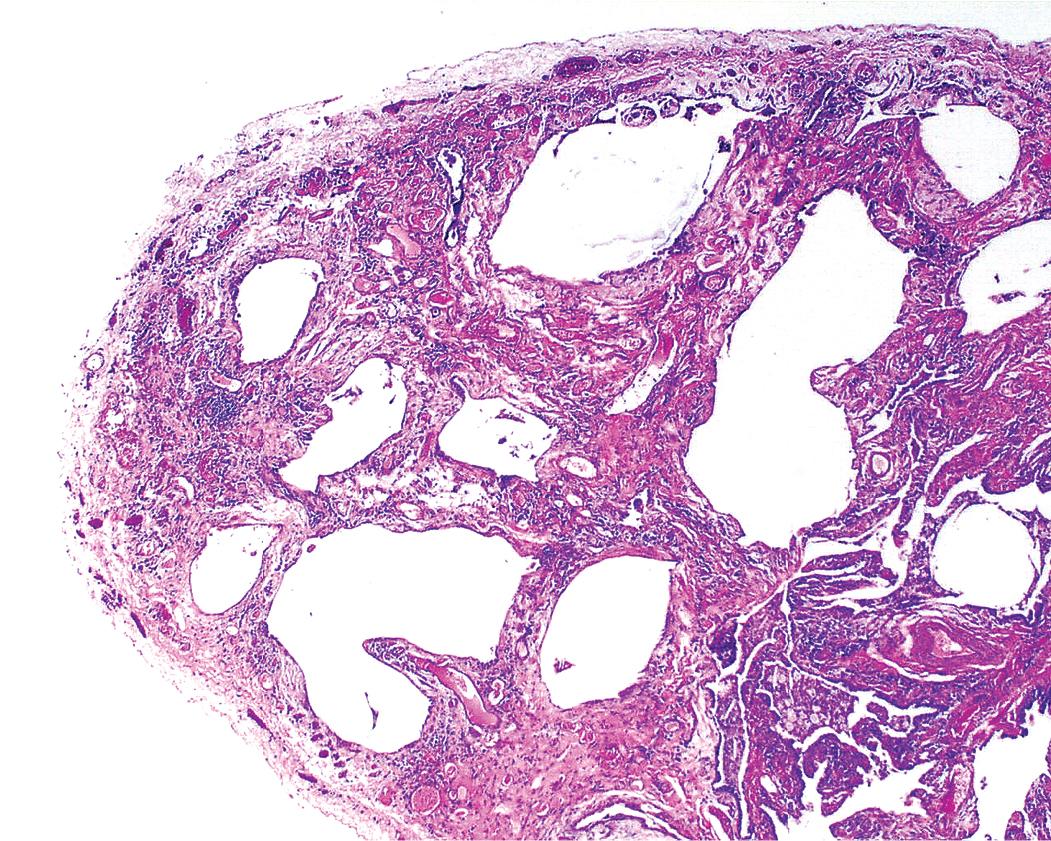 Figure 8.8, Usual interstitial pneumonia. Microscopic honeycomb cysts are considerably smaller (in the range of 1–3 mm in diameter) than those identified radiologically.