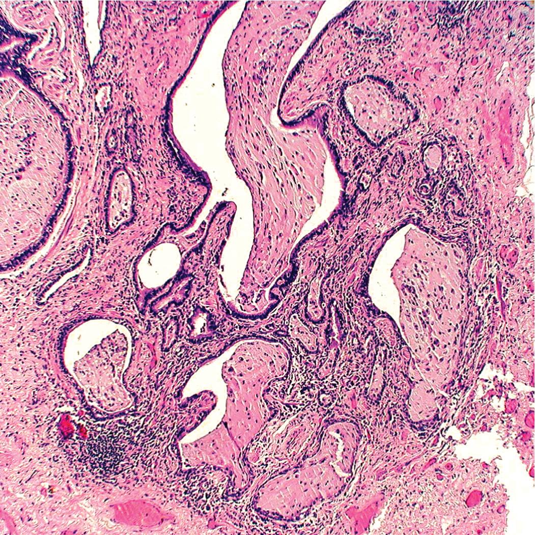 Figure 8.9, Usual interstitial pneumonia (UIP). Microscopic honeycomb cysts are lined by columnar ciliated epithelium and are typically filled with mucus, with variable amounts of acute inflammation and inflammatory debris. When dense chronic inflammation is present in UIP, it is most often seen around microscopic honeycombing.