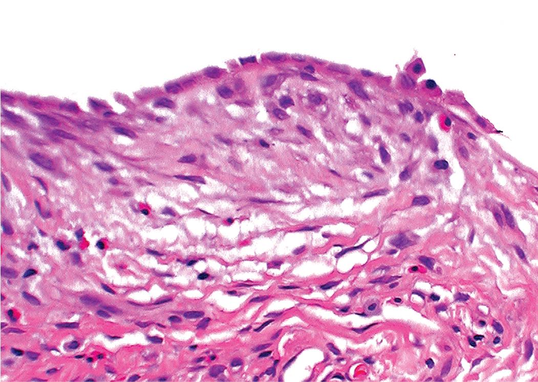 Figure 8.10, Usual interstitial pneumonia (UIP). The fibroblastic foci of UIP are patchy and present immediately beneath reactive-appearing cuboidal alveolar lining epithelium (type II cell hyperplasia). The fibroblastic proliferation bulges toward the airspace but does not appear to make a polypoid structure.