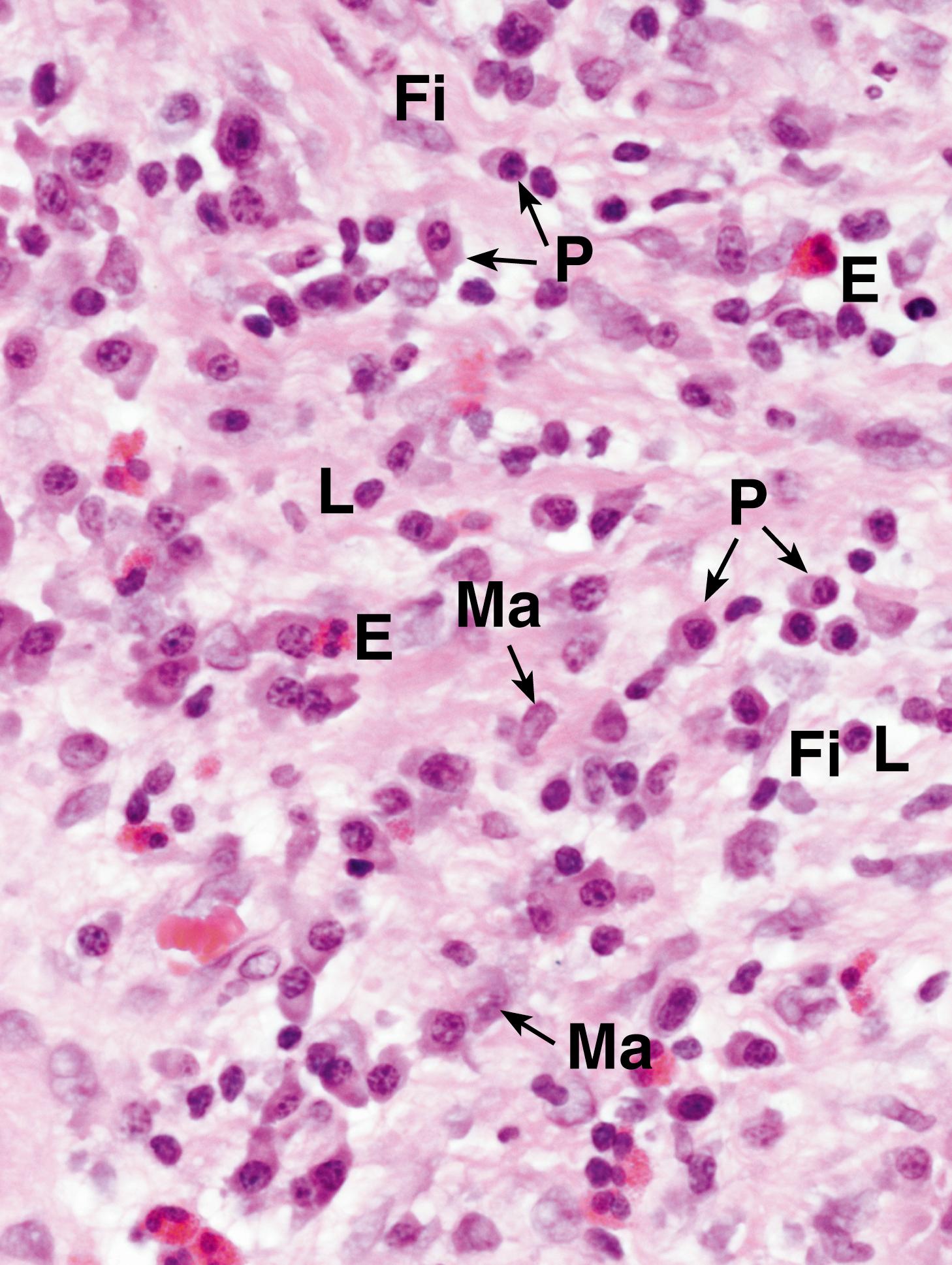 Fig. 4.1, Cells in chronic inflammation (HP).