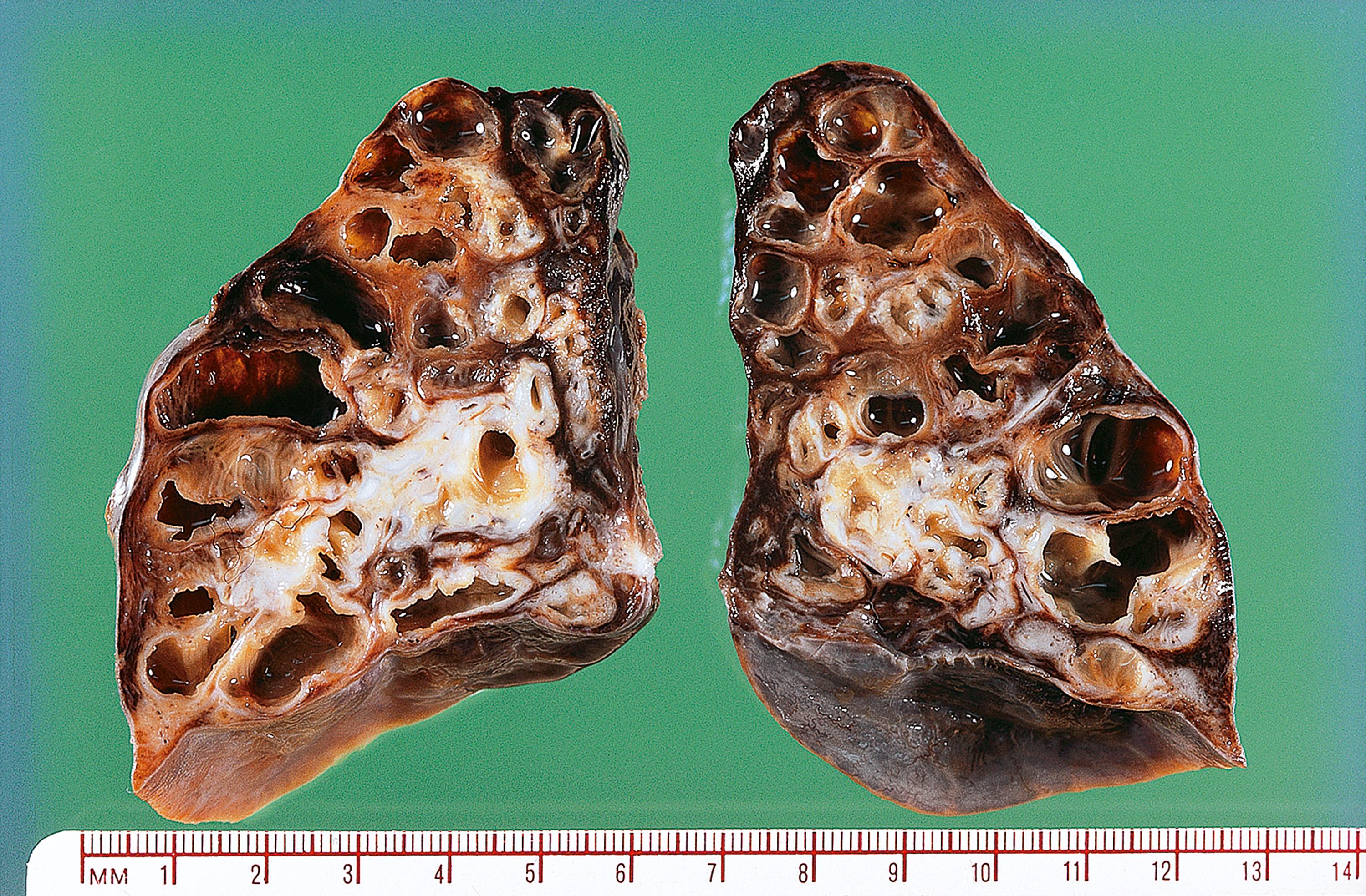 E-Fig. 4.3 G, Bronchiectasis. M/17. Left lower lobectomy was performed for chronic bronchiectasis. This patient had had recurrent attacks of pneumonia since the age of one year. The bronchial tubes are extremely dilated. Their walls are thickened and fibrotic and ‘ribbing’ can be seen along the mucosal surface of some of them. The adjacent lung has been almost completely destroyed. Surgical treatment of bronchiectasis is only useful when the condition is localised to one segment of the lung. Bronchiectasis of this severity is also seen in patients with cystic fibrosis. It can be prevented by aggressive medical and physiotherapy treatment of pneumonia in children.