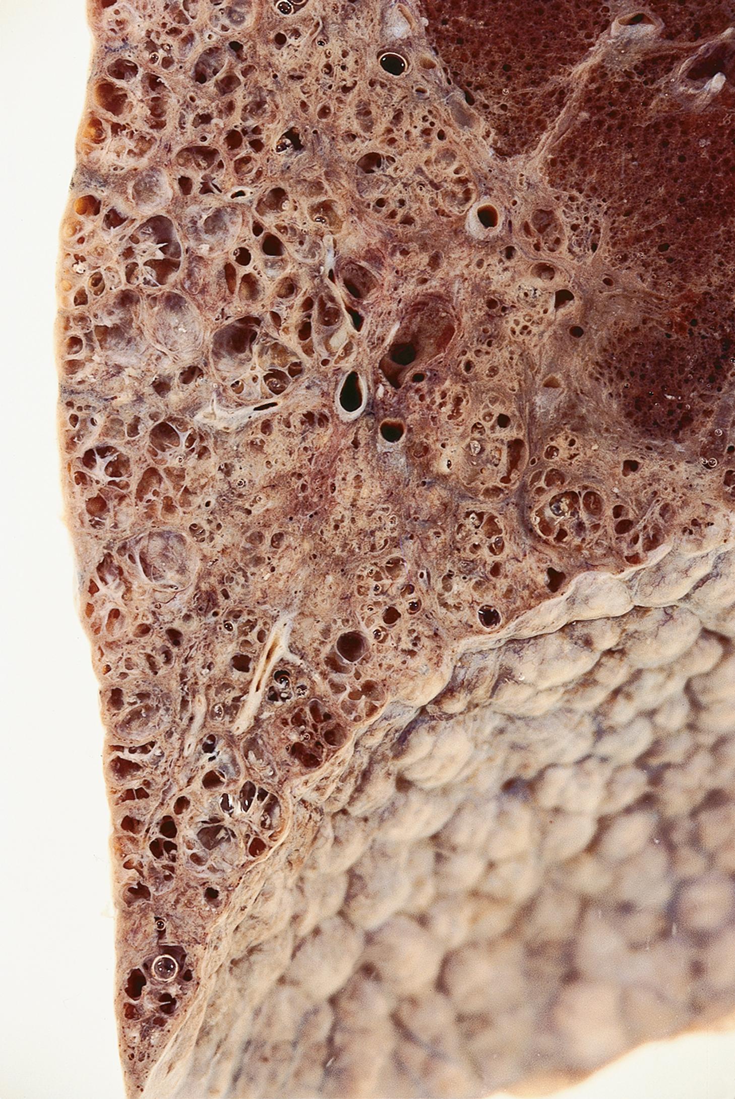 E-Fig. 4.6 G, Honeycomb lung. M/63. The patient had interstitial pulmonary fibrosis, the exact cause of which was not determined.