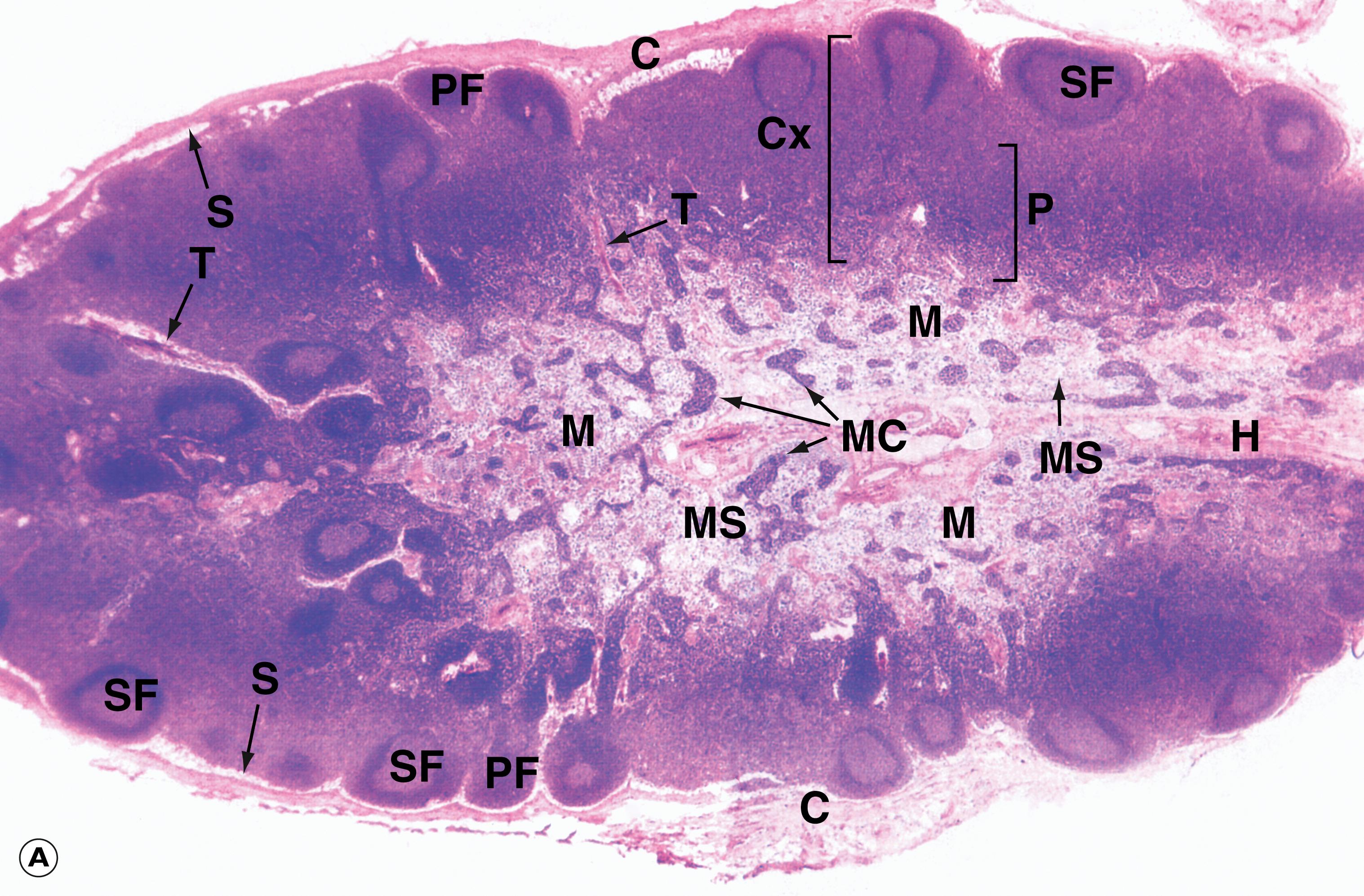 E-Fig. 4.7 H, Lymph node structure and vascular organisation. (A) H&E (LP); (B) schematic diagram. Lymph nodes are small, bean-shaped organs situated in the course of lymphatic vessels such that lymph draining back to the bloodstream first passes through one or more lymph nodes. Inactive nodes are only a few millimetres long but may increase greatly in size when mounting an active immunological response. Most lymph nodes in the body show some degree of ‘reactive change’ in response to the constant barrage of antigen to which they are exposed. As shown in micrograph (A) , the outer part of the lymph node is highly cellular and is known as the cortex Cx , whilst the central area, the medulla M , is less cellular. At the hilum H , the efferent lymphatic drains efferent lymph from the lymph node. The hilum is also the site of entry of the artery bringing blood to the lymph node and the vein leaving the node. The lymph node is surrounded by a collagenous capsule C from which trabeculae T extend for a variable distance into the substance of the node. Afferent lymphatic vessels , as shown in diagram (B) , divide into several branches outside the node then pierce the capsule to drain into a narrow space called the subcapsular sinus S that encircles the node beneath the capsule. From here, a labyrinth of channels called cortical sinuses passes towards the medulla through the cortical cell mass; sinuses adjacent to the trabeculae ( trabecular sinuses ) pursue a more direct course towards the medulla, but nevertheless form part of the cortical sinus system. The cortical sinuses are generally difficult to visualise because of their highly convoluted shape and numerous fine extensions that penetrate the cellular mass of the cortex. The superficial cortex contains a number of dense cellular aggregations, the follicles . Most of these in this particular example are secondary follicles SF with a pale-stained germinal centre ; others are inactive primary follicles PF . B cells respond to antigen in the cortex and undergo stimulation, clonal expansion and maturation in the follicles, the presence of germinal centres indicating that an active immune response is underway.The deeper cortex or paracortex P is also densely cellular but has a more homogeneous staining appearance. T lymphocytes interact with antigen presenting cells in the paracortex and undergo a similar process of activation and clonal expansion. T helper cells migrate towards the cortex to provide ‘help’ to B cells while activated cytotoxic T cells leave the node to perform their functions in the periphery. At the left of the field, some lymphoid follicles appear to be located deep in the paracortex; this is not the case but is a product of the plane of section, which passes at that point through the superficial cortex. The dominant feature of the medulla is the network of broad interconnected lymphatic channels called medullary sinuses MS that converge upon the hilum in the concavity of the node. Lymph drains from the hilum in the efferent lymphatic into one or more additional nodes, which in turn drain into more proximal nodes before eventually joining the blood stream via the thoracic duct or right lymphatic duct . Thus the lymph is filtered through a number of lymph nodes to facilitate the exposure of large numbers of lymphocytes to antigens in the lymph. Extensions of the cortical cell mass extend into the medulla as medullary cords MC . The blood supply of the lymph node, as shown in diagram (B) , is derived from one or more small arteries which enter at the hilum and branch in the medulla, giving rise to extensive capillary networks supplying the cortical follicles, paracortical zone and medullary cords. The vascular system provides the main route of entry of lymphocytes into the node, as well as supplying its metabolic requirements. Within the paracortex, the postcapillary high endothelial venules (HEV) have a cuboidal endothelium specialised for the exit of lymphocytes. Recognition by lymphocytes of these exit sites requires the presence of specific complementary adhesion molecules on the surface of both the endothelial cells and lymphocytes. Different groups of lymphocytes home to different tissues. Thus lymphocytes from the mucosa of the gut migrate to mesenteric lymph nodes, then to the spleen and back to mucosal tissues. Lymphocytes from the skin travel to their regional lymph nodes and then return to the skin. This is made possible by the different adhesion molecules or vascular addressins in the HEV of the different lymph node groups and the corresponding binding molecules on the lymphocytes. The HEV drain into small veins that leave the node via the hilum.