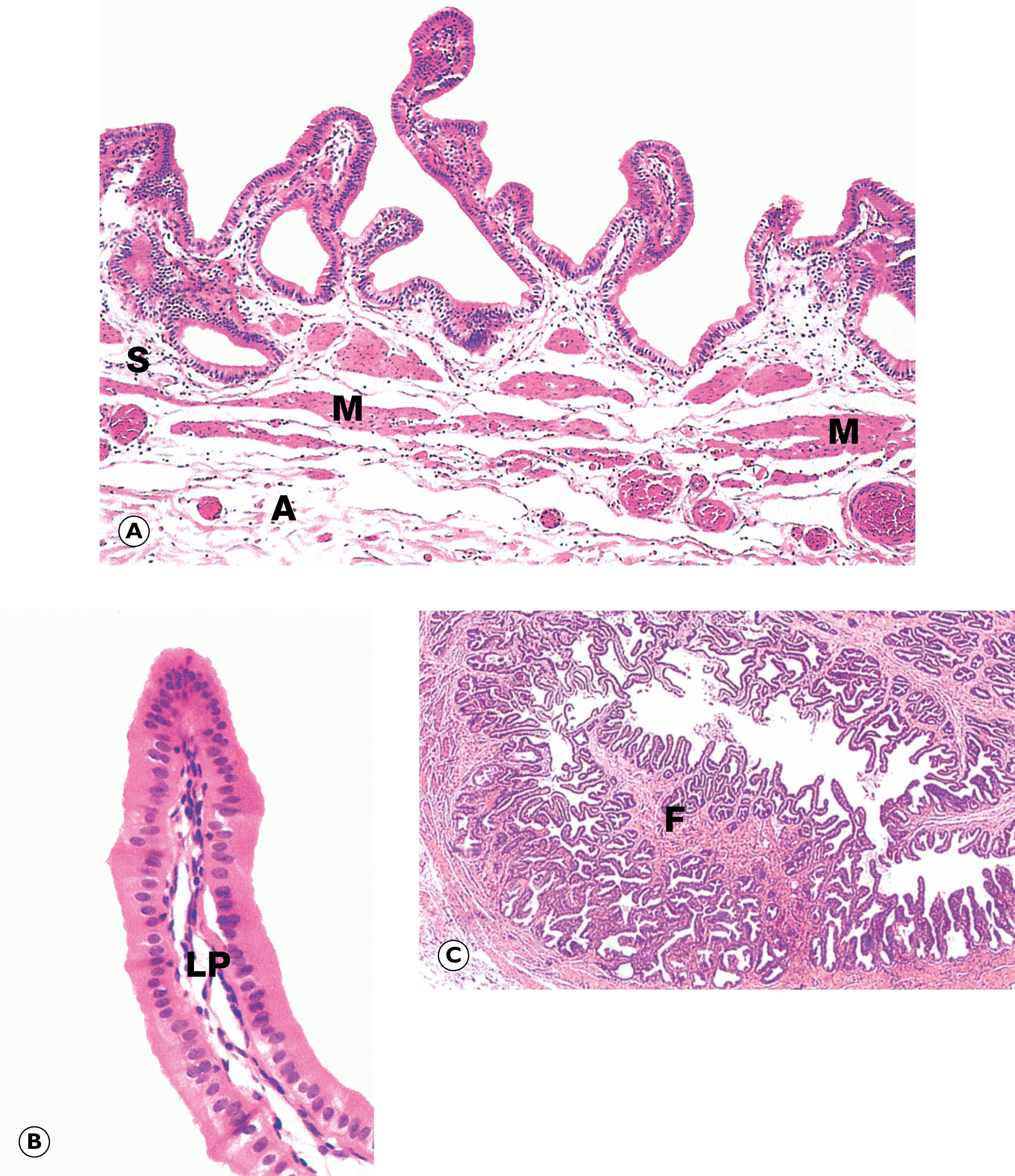 E-Fig. 4.8 H, Gallbladder. (A) H&E (LP); (B) H&E (MP); (C) H&E (LP). The intrahepatic bile collecting system merges to form right and left hepatic ducts which join, creating a single large duct, the common hepatic duct. On leaving the liver, this is joined by the cystic duct which drains the gallbladder. The common bile duct so formed joins the pancreatic duct to form the short ampulla of Vater before entering the duodenum. Bile draining down the common hepatic duct is shunted into the gallbladder where it is stored and concentrated. The major bile ducts outside the liver are collectively called the extrahepatic biliary tree .The gallbladder is a muscular sac lined by a simple columnar epithelium. It has a capacity of about 100 mL in humans. The presence of lipid in the duodenum promotes the secretion of the hormone cholecystokinin-pancreozymin (CCK) by neuroendocrine cells of the duodenal mucosa, stimulating contraction of the gallbladder and forcing bile into the duodenum. Bile is an emulsifying agent, facilitating the hydrolysis of dietary lipids by pancreatic lipases. Micrograph (A) shows the wall of a gallbladder in the non-distended state in which the mucosa is thrown up into many folds. The relatively loose submucosa S is rich in elastic fibres, blood vessels and lymphatics which drain water reabsorbed from bile during the concentration process. The fibres of the muscular layer M are arranged in longitudinal, transverse and oblique orientations but do not form distinct layers. Externally, there is a thick collagenous adventitial (serosal) coat A , conveying the larger blood and lymphatic vessels. In the neck of the gallbladder and in the extrahepatic biliary tree, mucous glands are found in the submucosa. Mucus may provide a protective surface film for the biliary tract. At high magnification in micrograph (B) , the simple epithelial lining of the gallbladder is seen to consist of very tall columnar cells with basally located nuclei. Numerous short, irregular microvilli account for the unevenness of the luminal surface. The lining cells concentrate bile 5- to 10-fold by an active process, the resulting water passing into lymphatics in the lamina propria LP . Micrograph (C) illustrates the wall of the cystic duct, which is formed into a twisted mucosa-covered fold F known as the spiral valve of Heister . The flow of bile and pancreatic juice into the duodenum is controlled by the complex arrangement of smooth muscle known as the sphincter of Oddi . The components of this structure include the choledochal sphincter at the distal end of the common bile duct, the pancreatic sphincter at the end of the pancreatic duct, and a meshwork of muscle fibres around the ampulla. This arrangement controls the flow of bile and pancreatic juice into the duodenum and, at the same time, prevents reflux of bile and pancreatic juice into the wrong parts of the duct system. When the choledochal sphincter is closed, bile is directed into the gallbladder where it is concentrated.