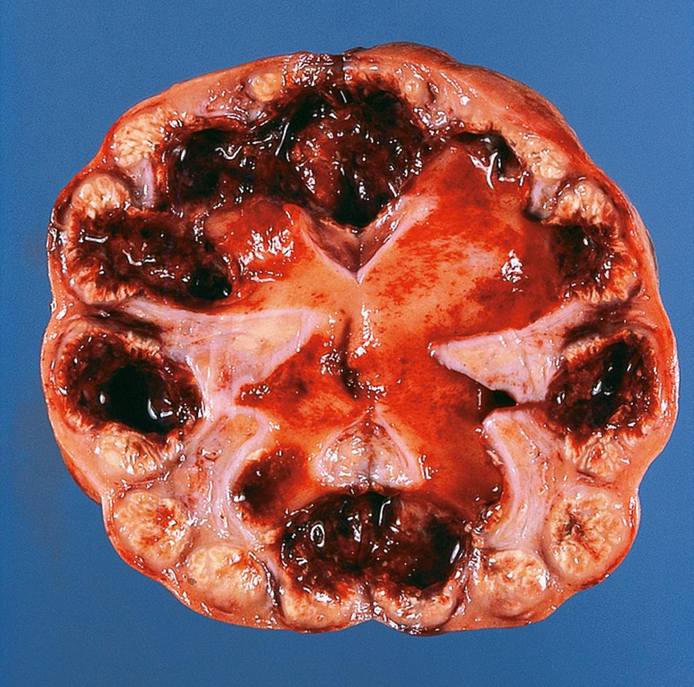 E-Fig. 4.9 G, Xanthogranulomatous pyelonephritis. F/60. The kidney is opened to show the features of acute pyelonephritis, together with large areas of haemorrhage and lipid accumulation. These features occur in a small percentage of cases of pyelonephritis, but do not appear to have any special significance.