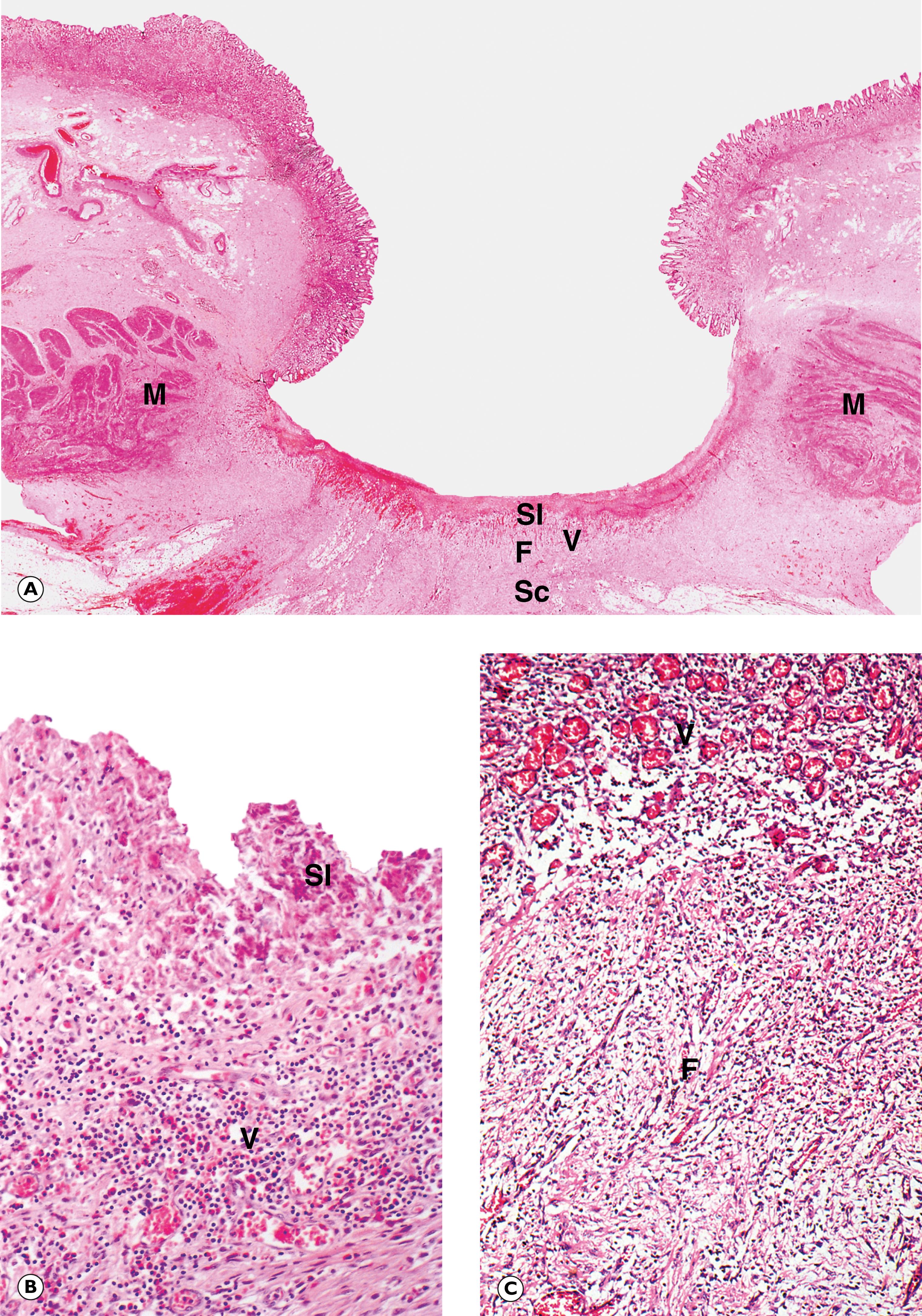 Fig. 4.2, Chronic peptic ulcer. (A) Entire ulcer (LP); (B) surface layers of ulcer (MP); (C) deep layers of ulcer (MP).