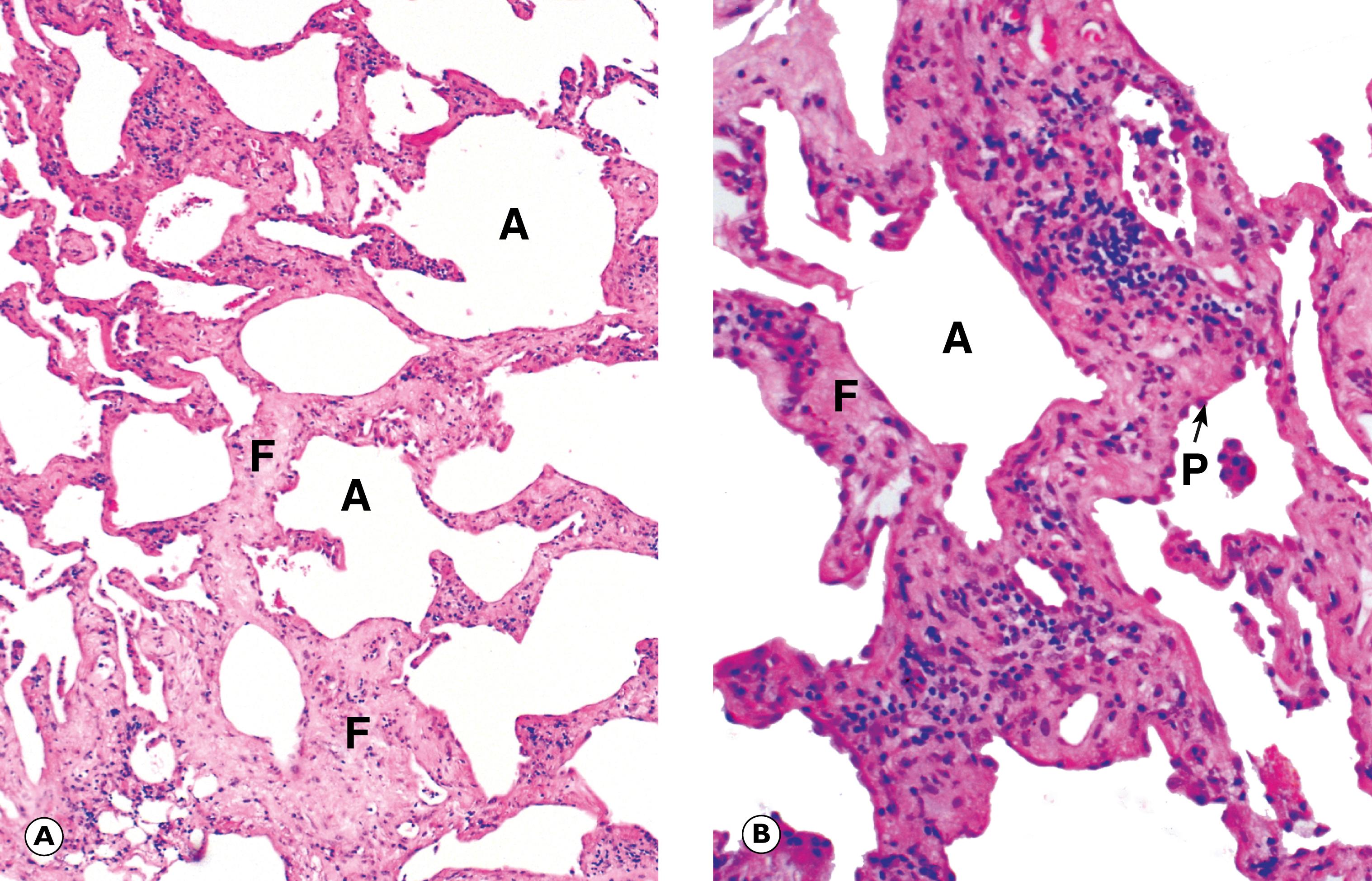 Fig. 4.5, Pulmonary fibrosis (idiopathic). (A) LP; (B) HP.