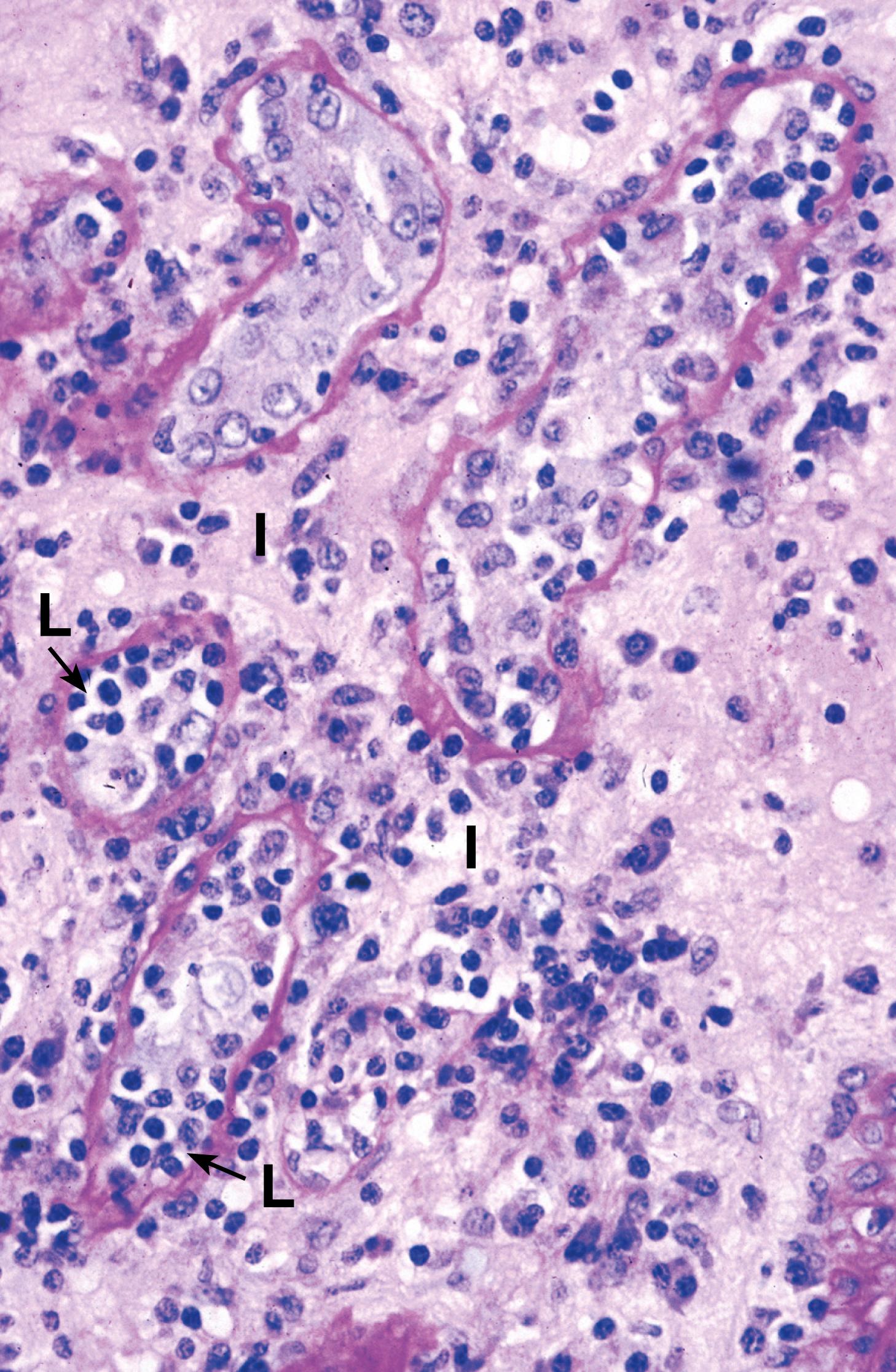 Fig. 4.6, Transplant rejection: kidney (LP).