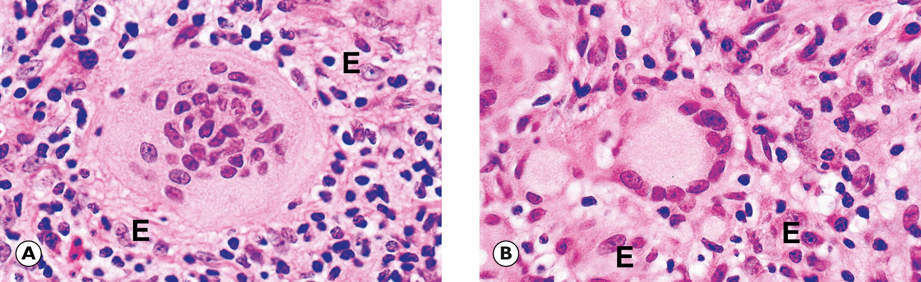 Fig. 4.7, Giant cells. (A) Foreign body giant cell (HP); (B) Langhans’ giant cell (HP).