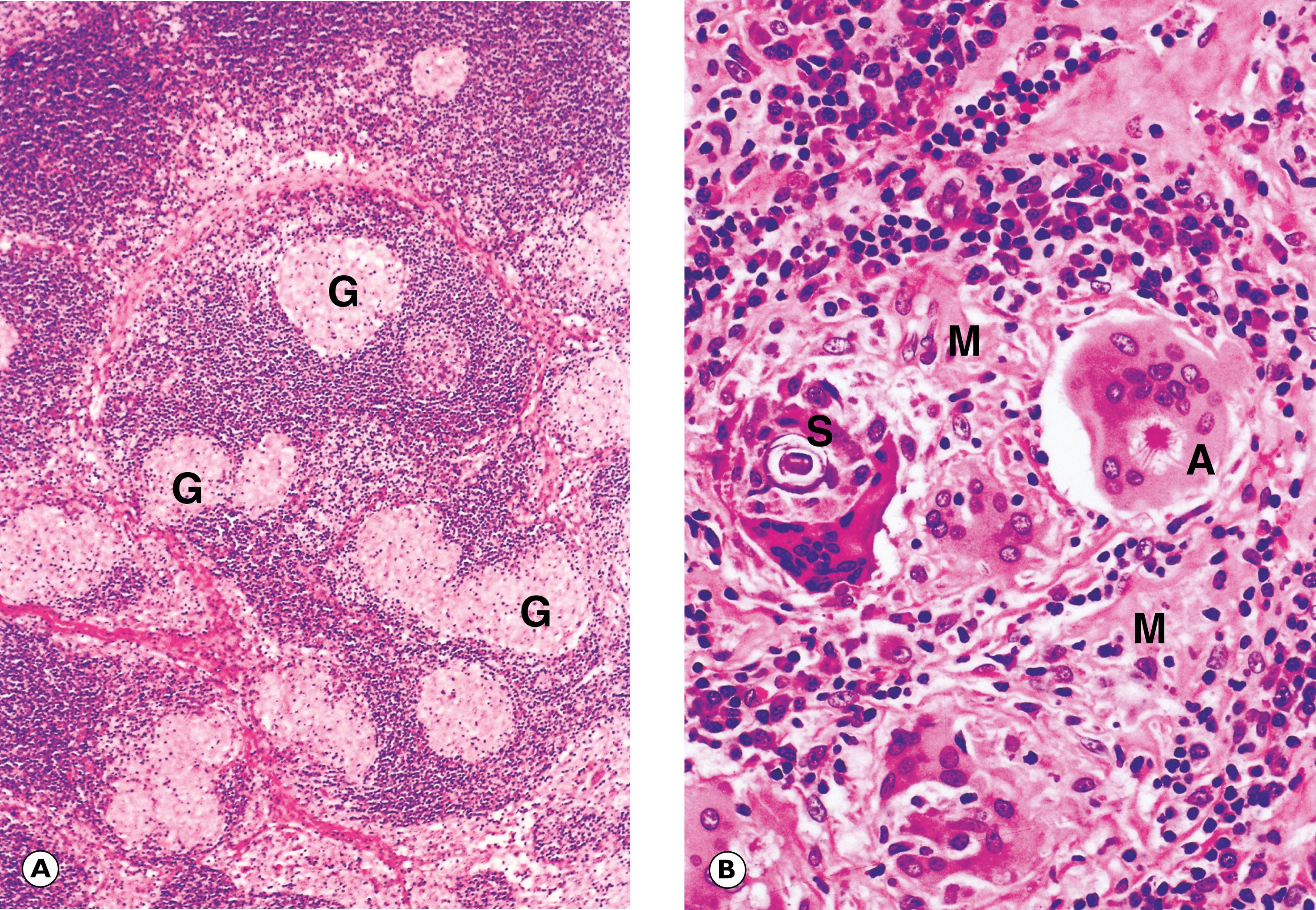 Fig. 4.8, Sarcoidosis. (A) Sarcoidosis in a lymph node (MP); (B) sarcoid granulomas (HP).