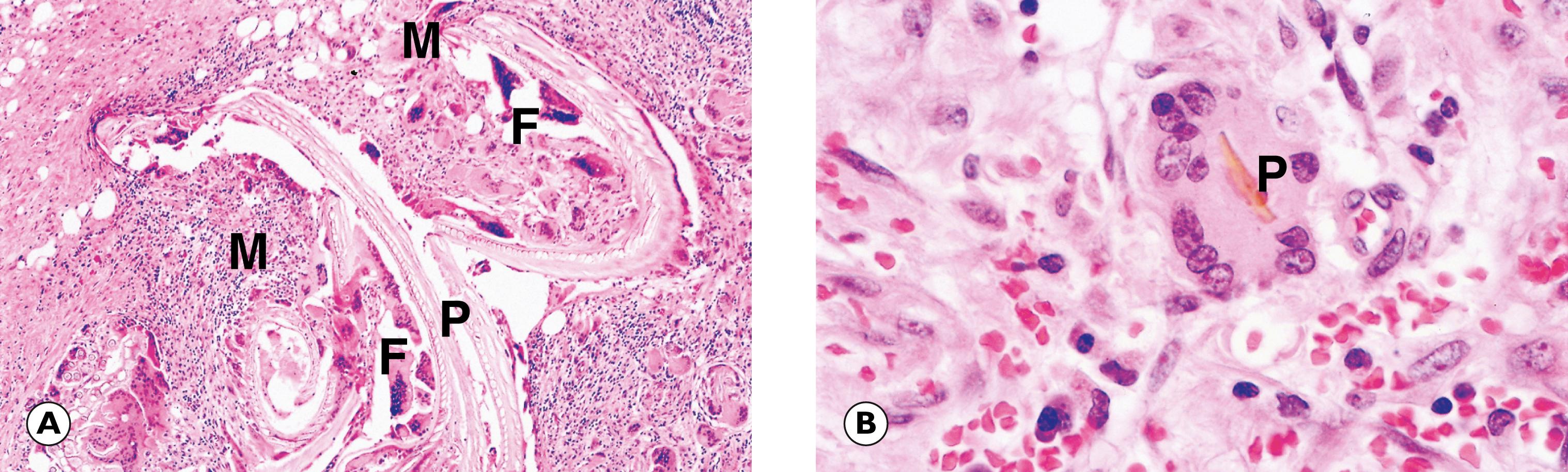 Fig. 4.9, Foreign body reaction. (A) Foreign body granuloma (LP); (B) giant cell with inclusion (HP).