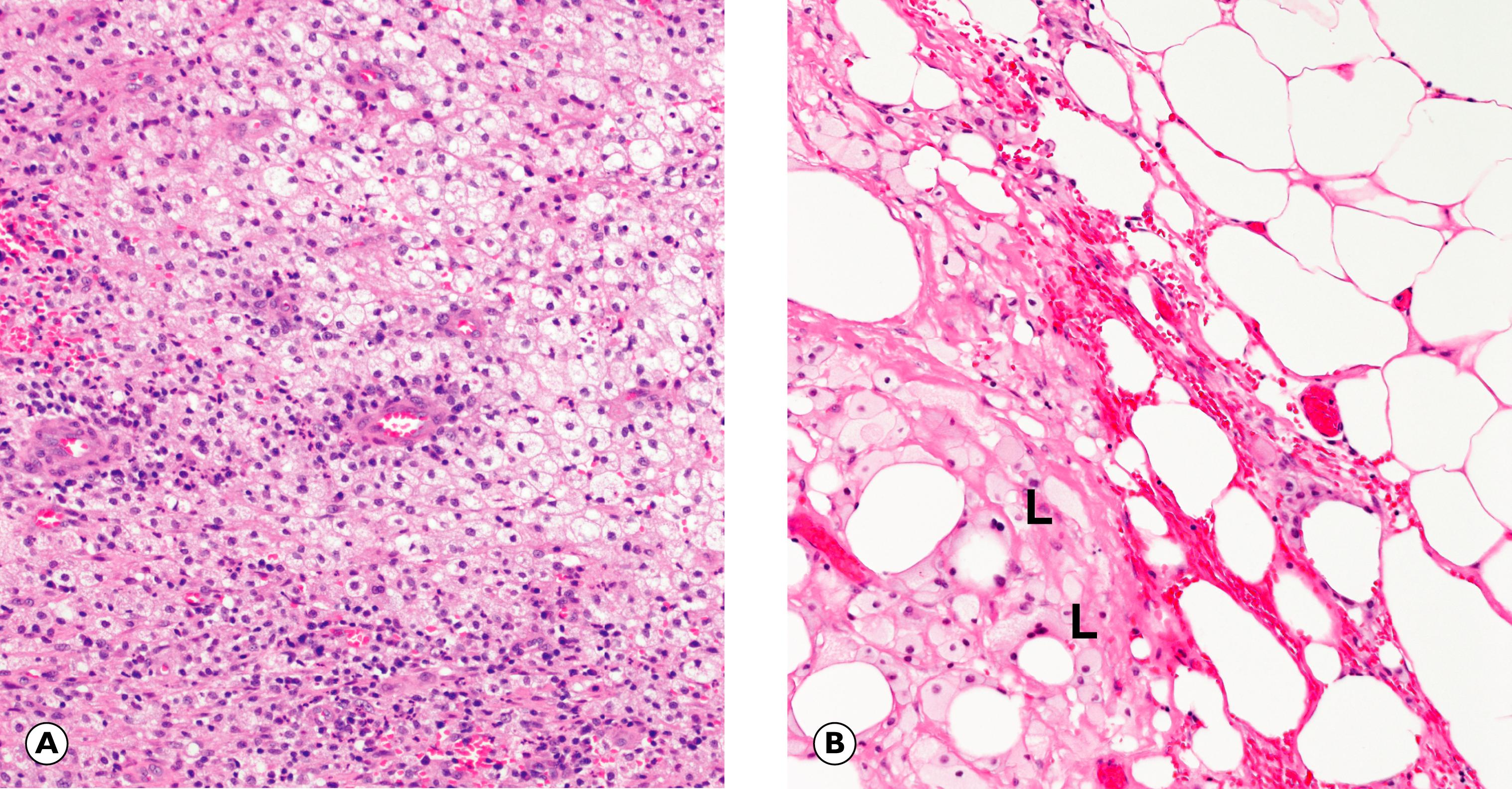 Fig. 4.10, Xanthogranulomatous inflammation and lipogranuloma. (A) Xanthogranulomatous cholecystitis (MP); (B) lipogranuloma in fat necrosis (HP).