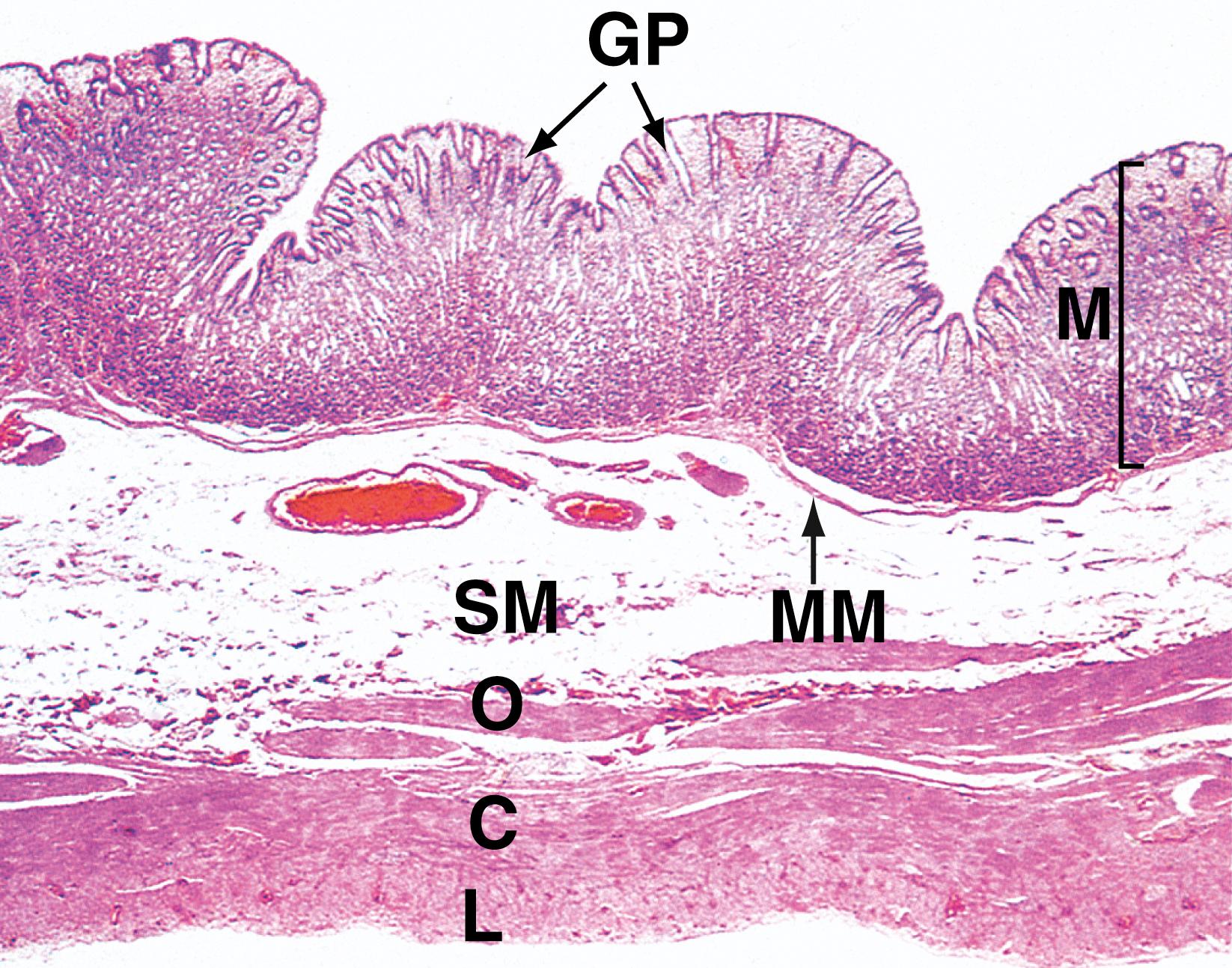 E-Fig. 4.1 H, Body of the stomach H&E (LP). This micrograph illustrates the body of the stomach in the non-distended state. The mucosa M is thrown into prominent folds or rugae and consists of gastric glands that extend from the level of the muscularis mucosae MM to open into the stomach lumen via gastric pits or foveolae GP . The muscularis propria comprises the usual inner circular C and outer longitudinal L layers, but the inner circular layer is reinforced by a further inner oblique layer O . The submucosa SM is relatively loose and distensible and contains the larger blood vessels. The serosal layer, which covers the peritoneal surface, is thin and barely visible at this magnification. The adipose tissue of the lesser and greater omentum is attached along the lesser and greater curvature of the stomach (not illustrated in this micrograph). Lymph nodes and large blood vessels lie within this omental fatty tissue.