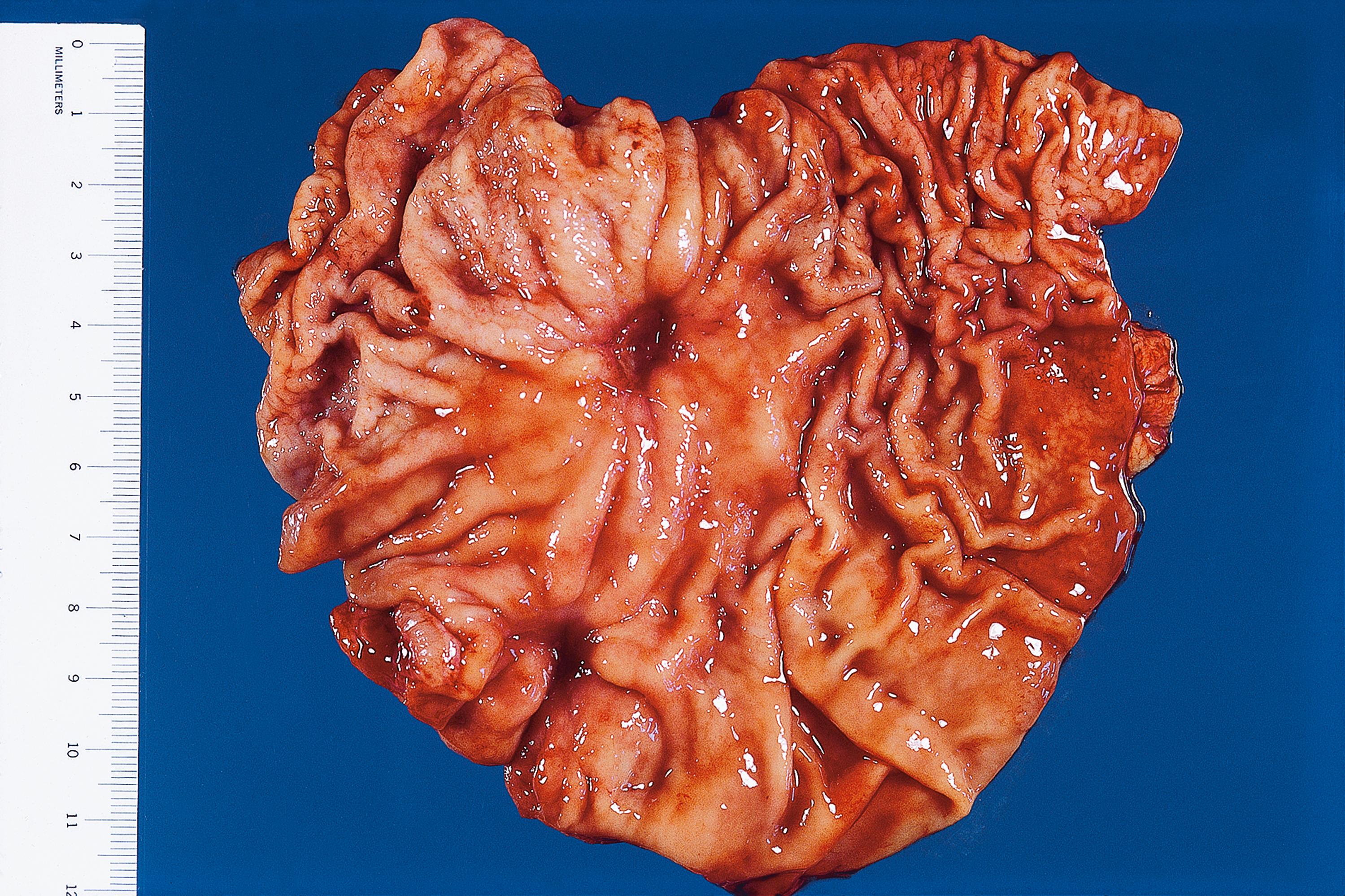 E-Fig. 4.2 G, Chronic peptic ulcer. M/44. A partial gastrectomy was performed because of haematemesis. There was a bleeding artery in the base of the ulcer.