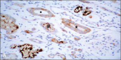 Fig. 15.1, Elafin staining in hematopoietic cell transplantation and control kidney samples. A. Intermediate-power image shows positive staining in a subset of tubules and negative glomerulus ( arrowhead ). This case demonstrated several patterns, including diffuse finely (*) and coarsely (upper right and lower left) granular, as well as coarse luminal granules (#) (3,3′-diaminobenzidine; original magnification, ×200). B. Finely granular cytoplasmic staining was most commonly diffusely distributed within the cytoplasm.