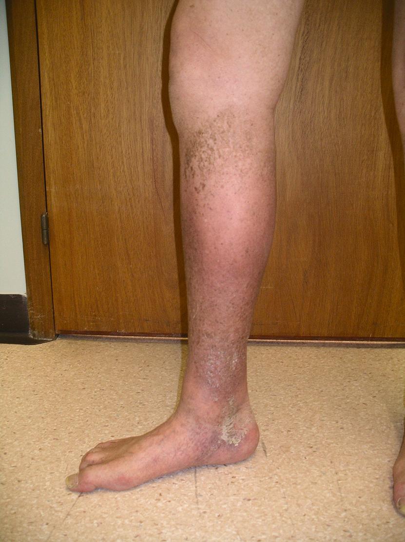 Figure 18.1, Chronic venous insufficiency with pigmentation and severe lipodermatosclerosis resulting in the typical ‘inverted champagne bottle’ shape.