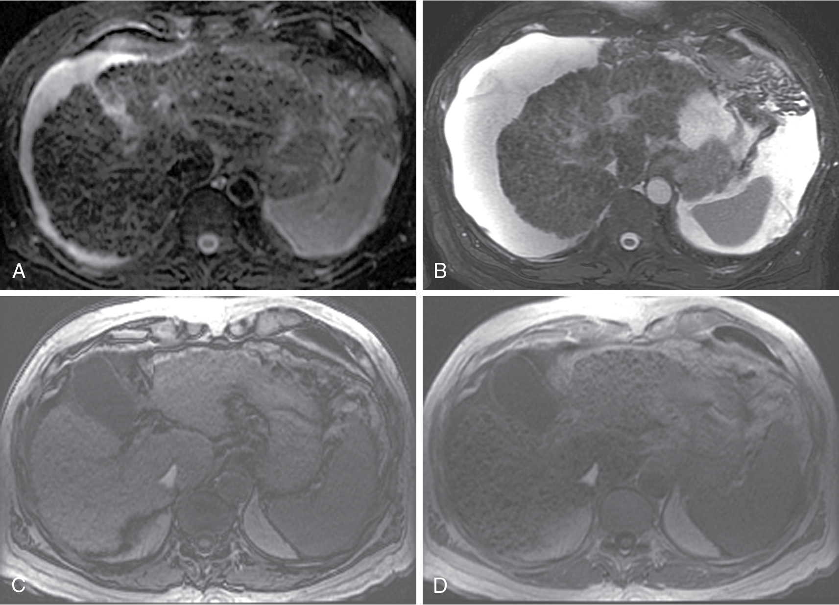 Fig. 15.1, Parenchymal nodularity with bridging bands of fibrosis. The axial, moderately T2-weighted, fat-suppressed images at baseline (A) and follow-up (B) portray advanced cirrhosis reflected by diffuse nodularity with intervening reticular hyperintensity, corresponding to fibrosis with worsening ascites. Comparing the out of-phase (C) with the in-phase (D) images reveals susceptibility artifact arising from the parenchymal (siderotic) nodules because of their iron content.