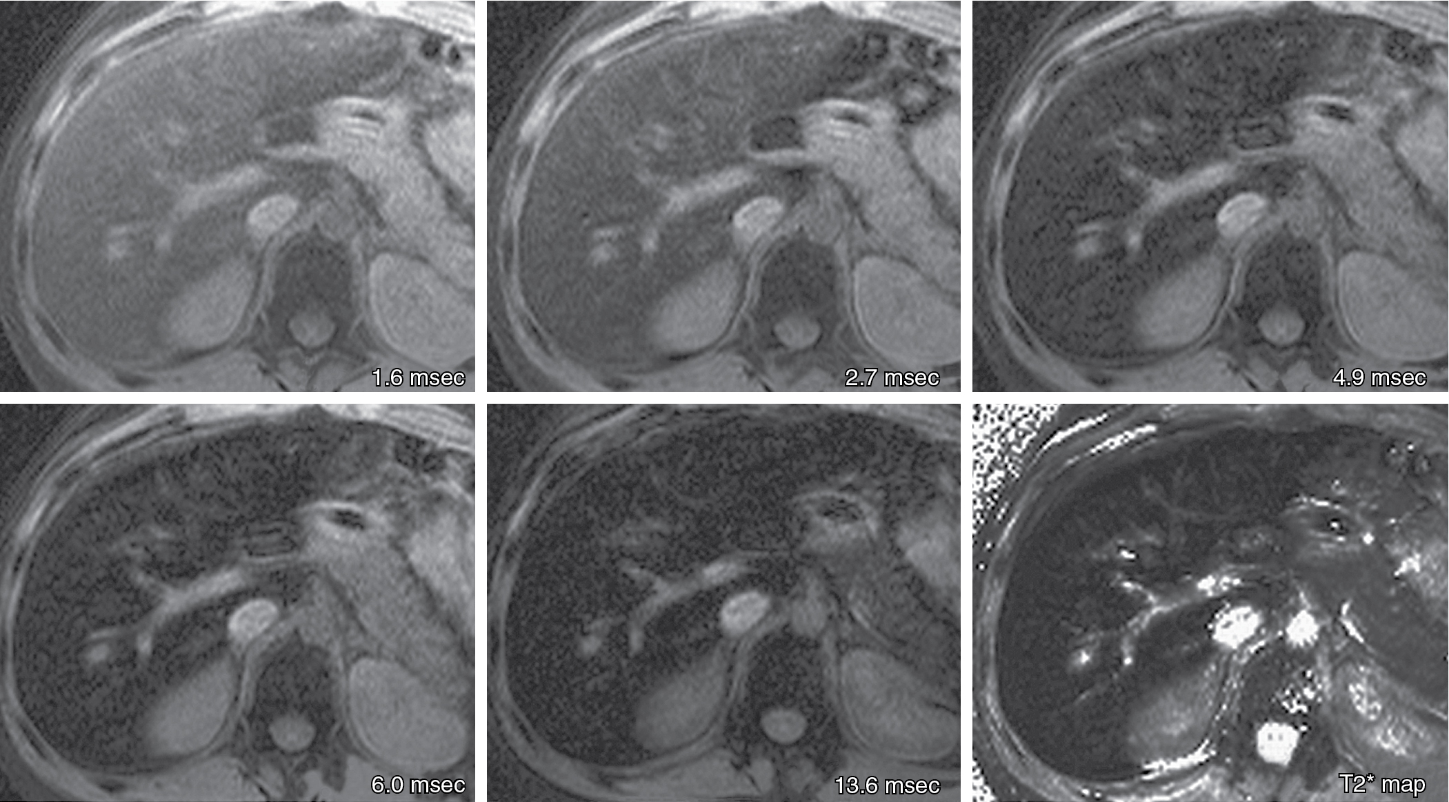 Fig. 15.2, A T2* map was generated by acquiring 12 colocalized fat-saturated spoiled gradient recalled echo magnetic resonance images. Echo times ranged from 1.6 to 13.6 ms. Of the series of 12 images, five are presented for illustrative purposes with echo times as shown. The T2* value was calculated assuming monoexponential signal decay from the 12 echoes. The estimated T2* relaxation value, 9 ms, suggests moderate iron overload.