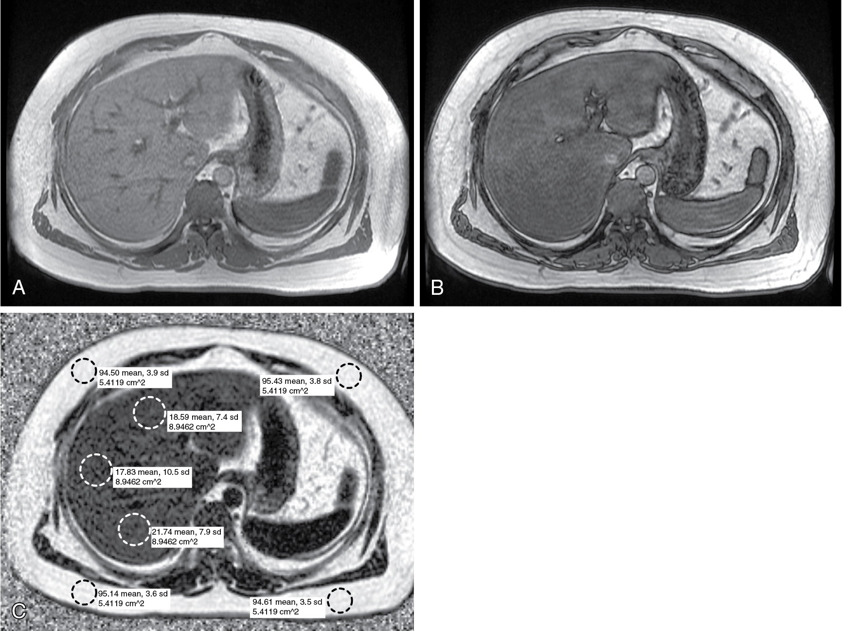 Fig. 15.3, Moderate phase cancellation signal loss is evident in the in- and out-of-phase images, (A) and (B) respectively. The proton density fat fraction image (C) assigns pixel signal intensity proportional to fat content, as reflected in the ROI measurements of the subcutaneous fat with the mean intensity of approximately 95% and the liver with a mean intensity of approximately 20% corresponding to the fat content.