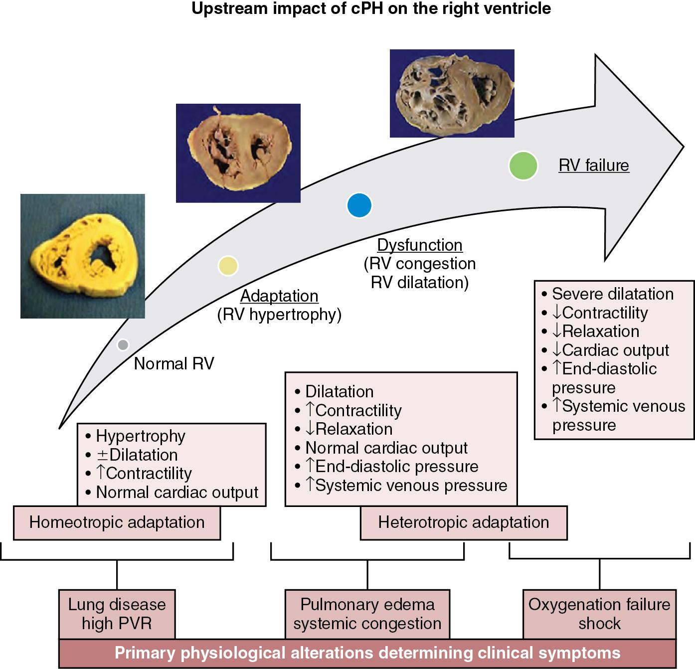 Fig. 26.2, Pathophysiological impact of sustained progressive rise of pulmonary vascular resistance ( PVR ) on the right ventricle ( RV ).